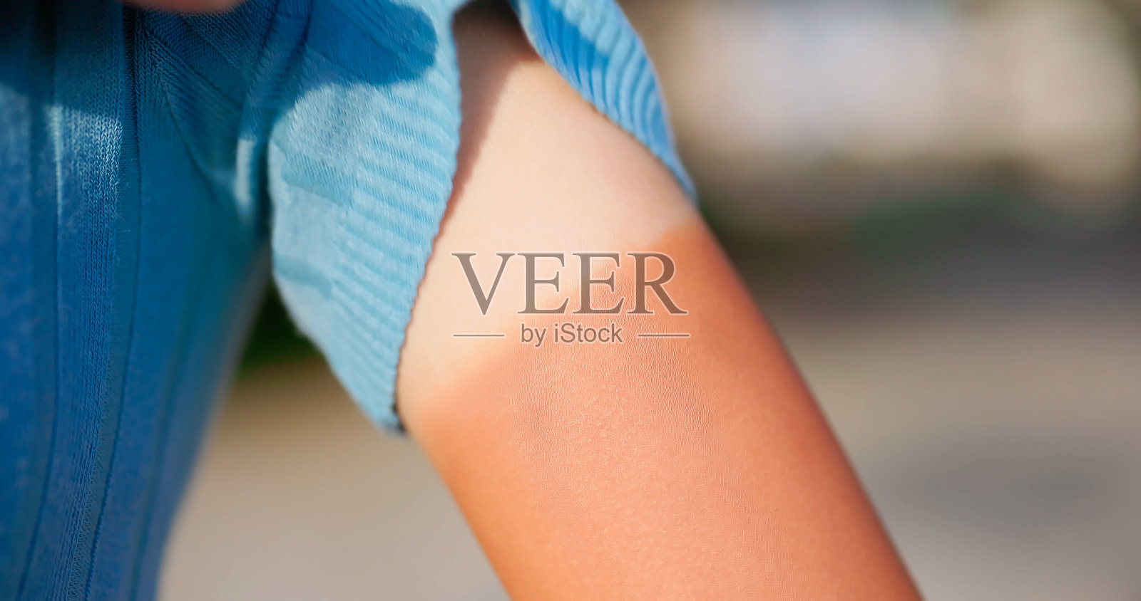 亚洲年轻女子晒伤的手臂照片摄影图片