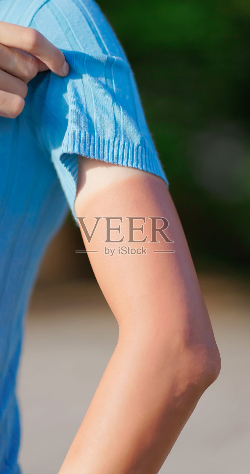 亚洲年轻女子晒伤的手臂照片摄影图片