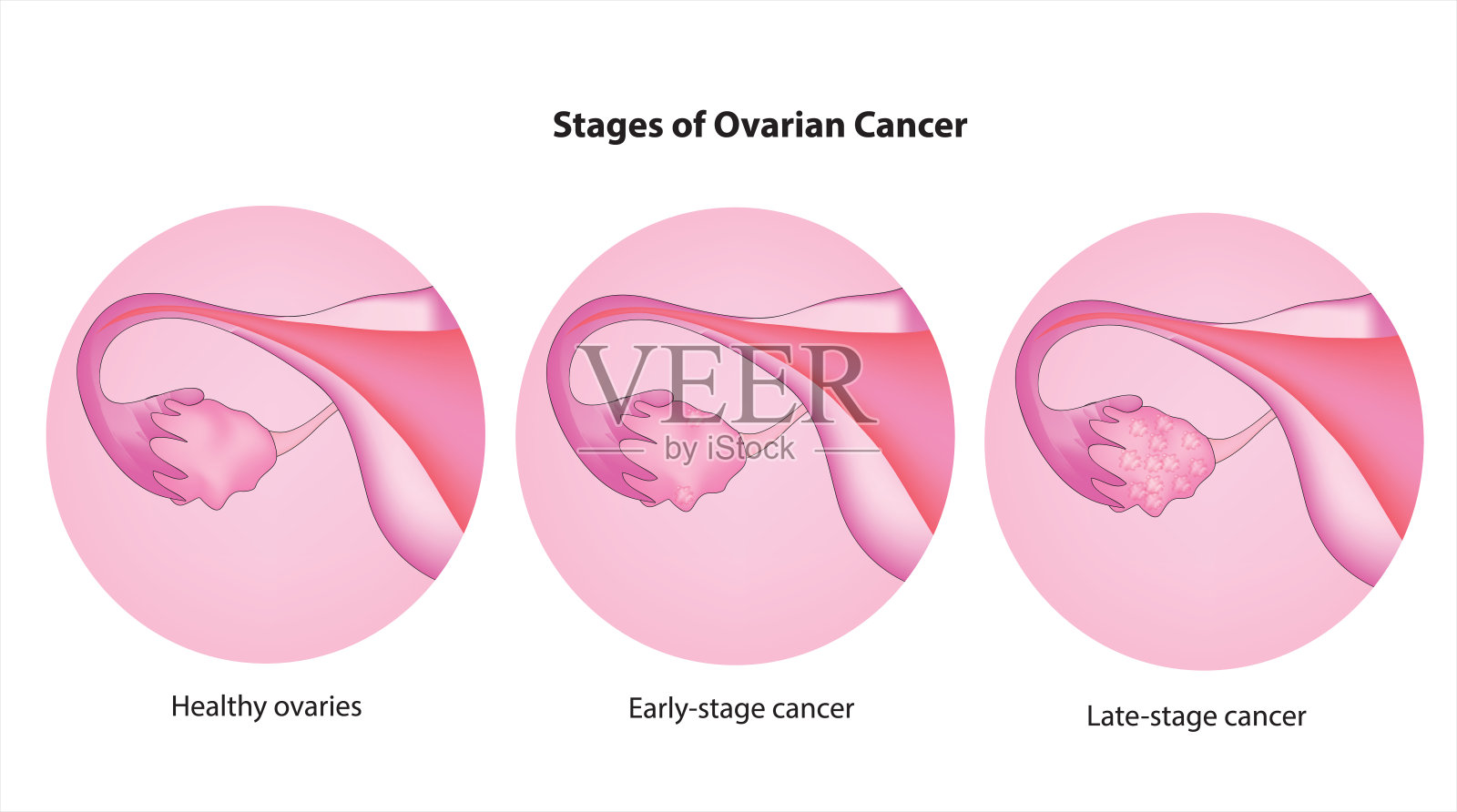 卵巢癌插画图片素材