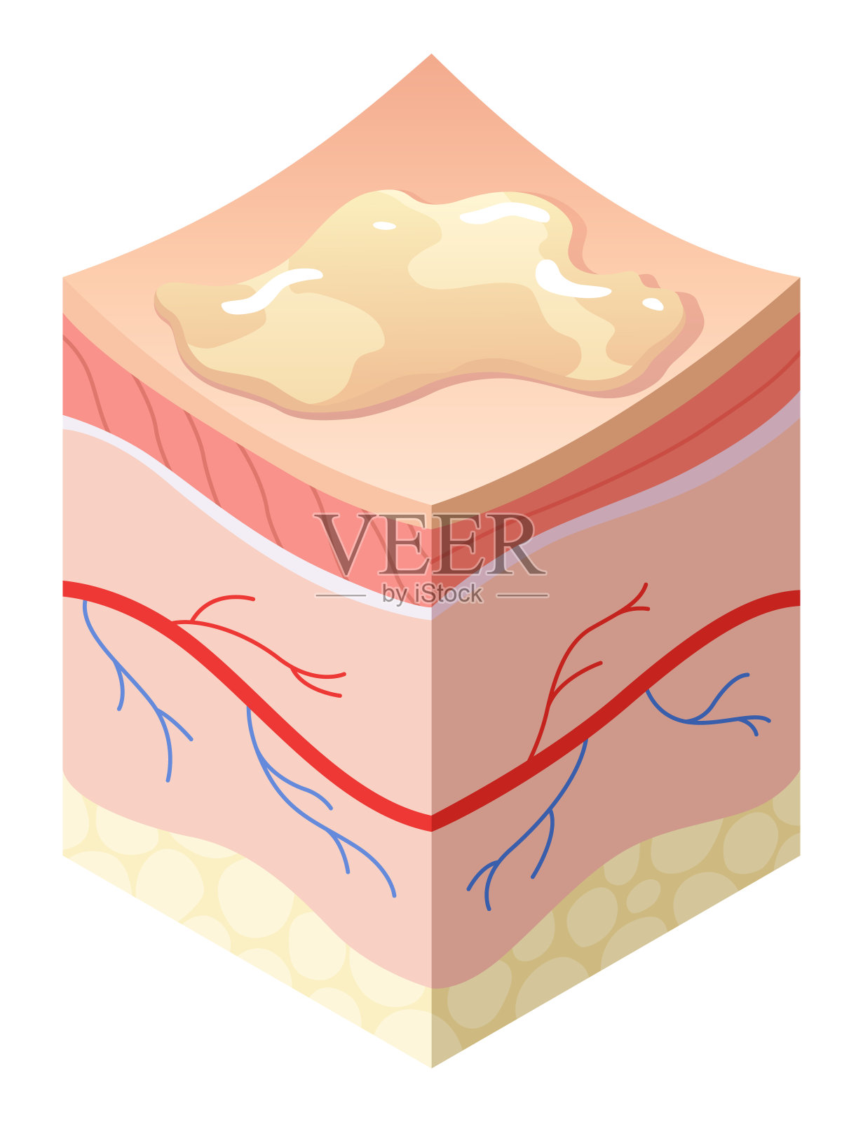 护肤医疗理念。人体皮肤横截面水平层结构的若干问题。解剖插图模型不健康的皮肤层插画图片素材