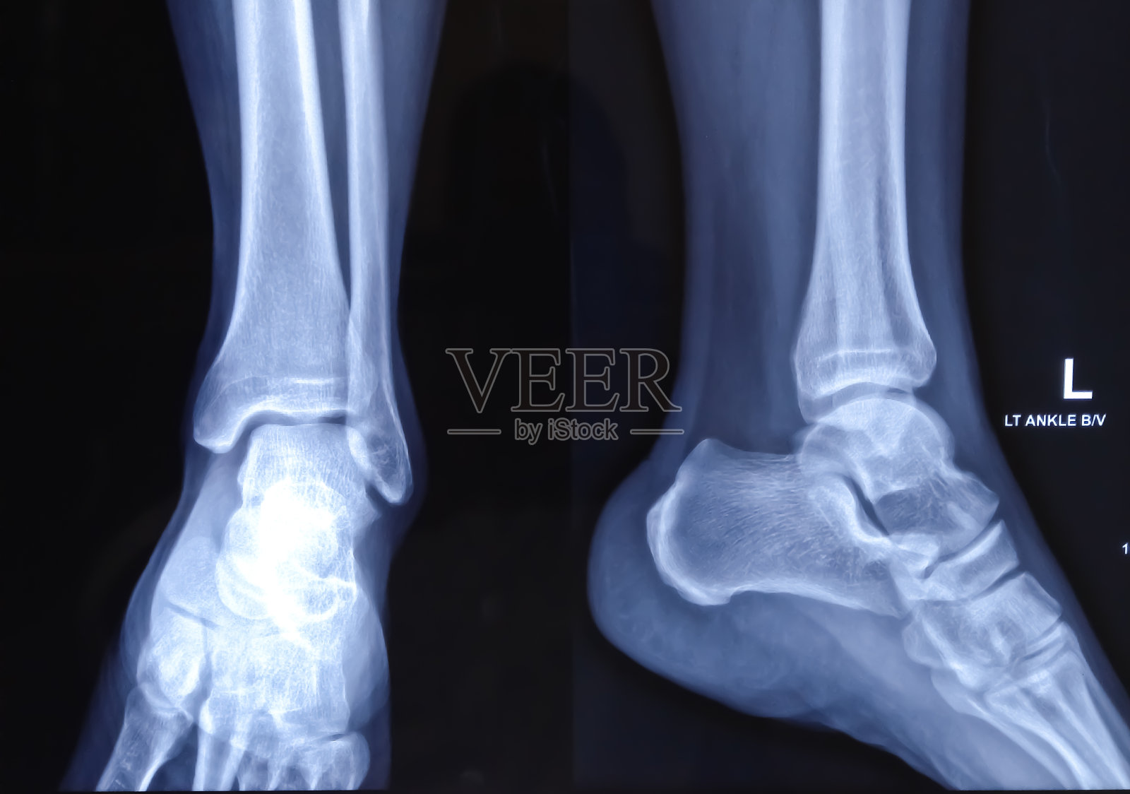踝关节的x光片或x光片，显示踝关节扭伤患者踝关节和足部骨骼和关节的解剖结构。照片摄影图片