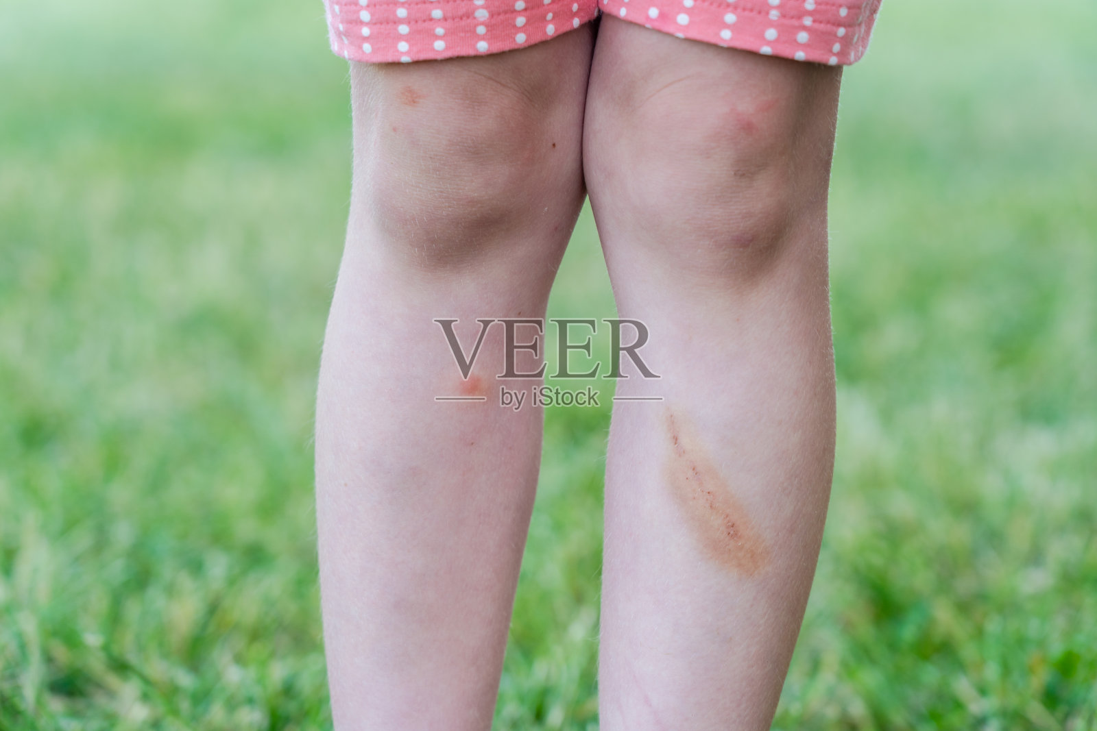 腿上有淤青的小孩。儿童瘀伤照片摄影图片