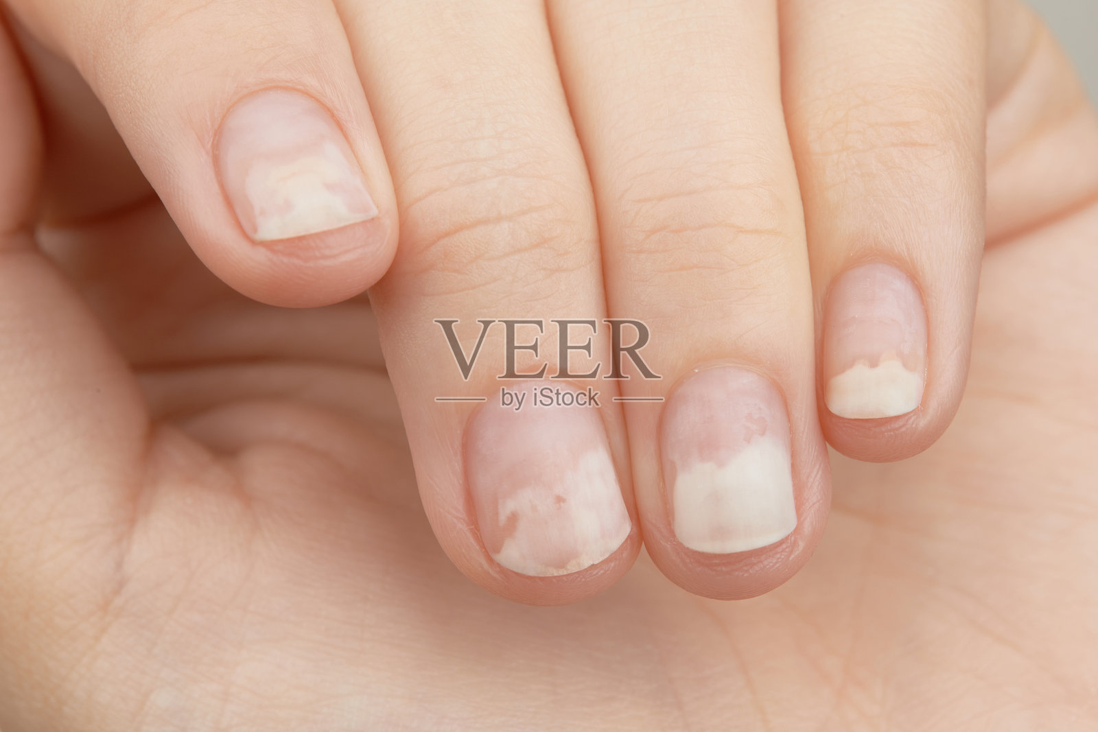 指甲去除啫喱油后出现骨髓炎。指甲受损的女人的手照片摄影图片