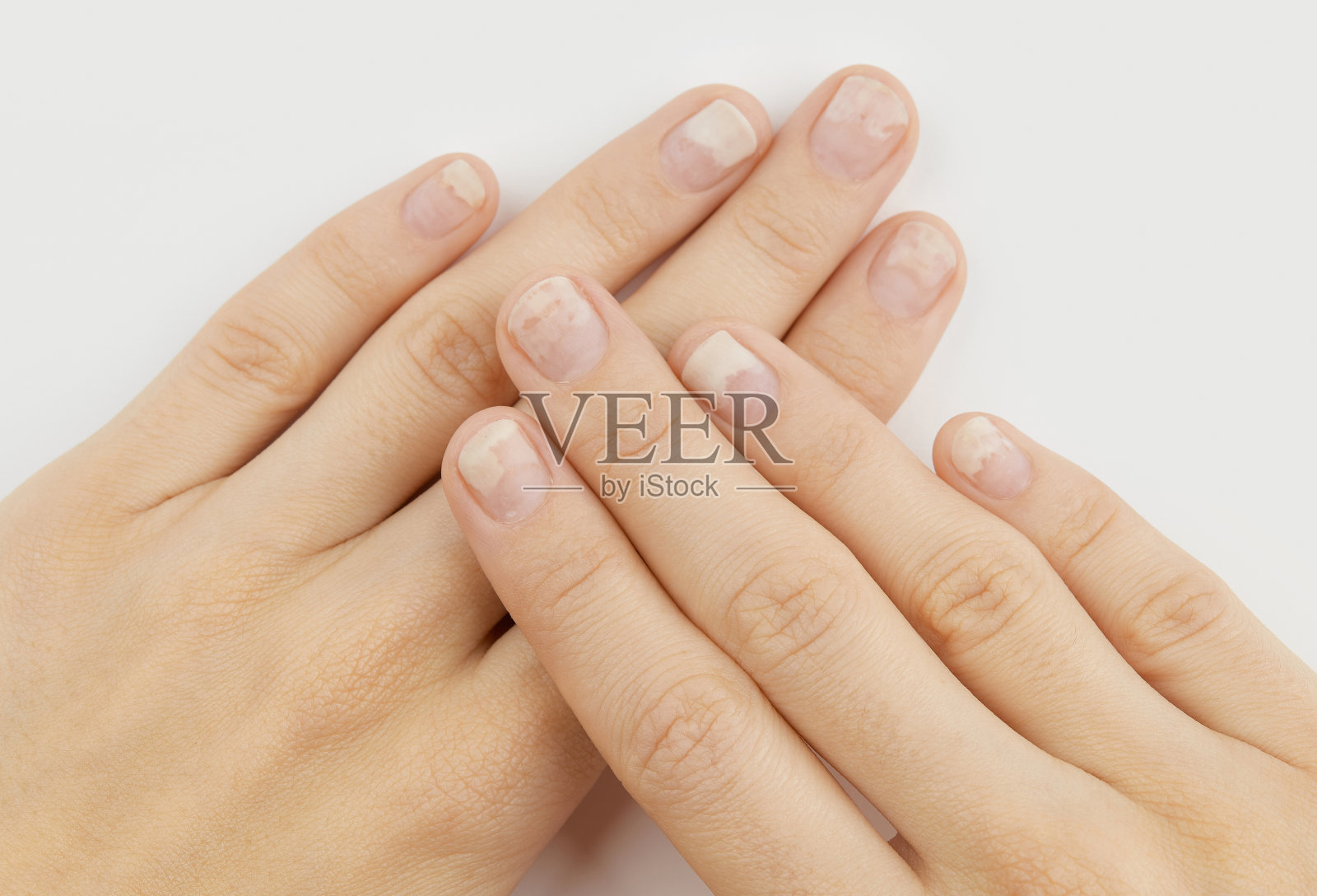 在灰色底色上去除凝胶擦亮剂后，指甲有骨化。指甲受损的女人的手照片摄影图片