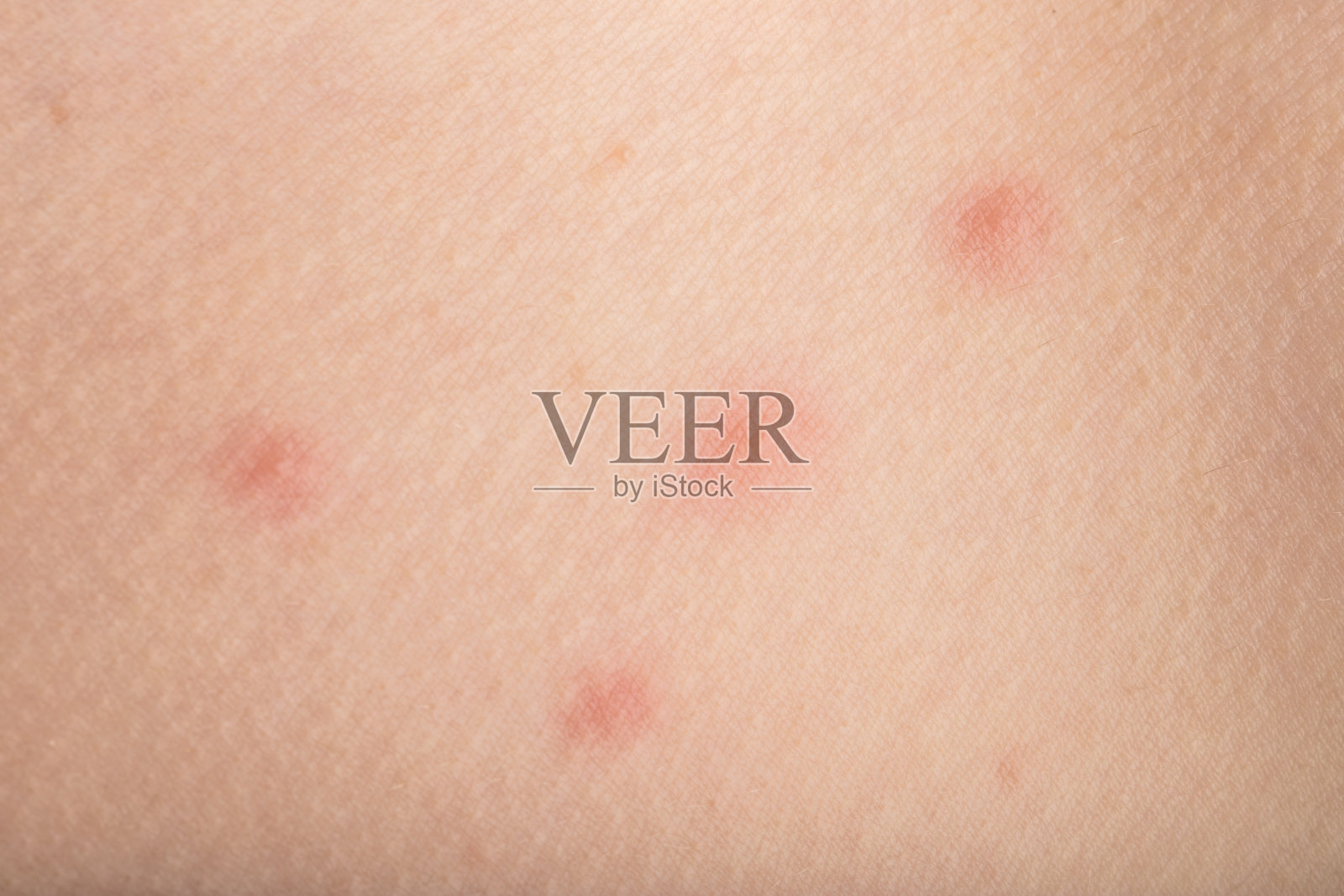 水痘(水痘)特写照片摄影图片