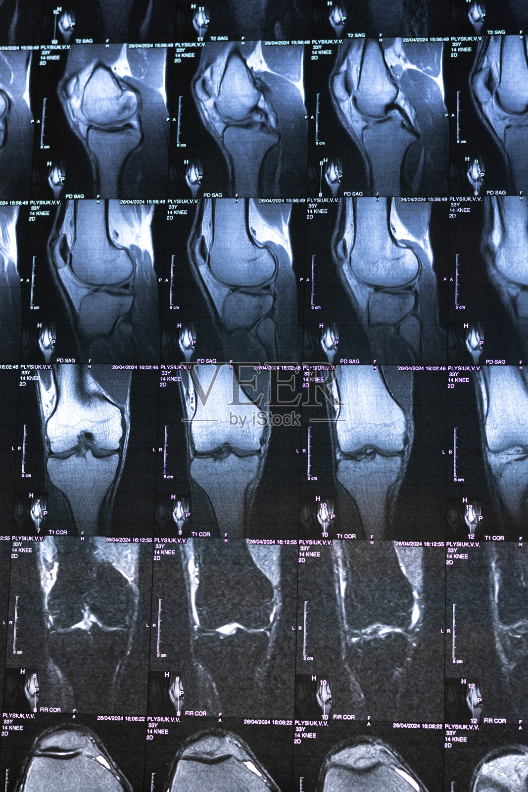 骨膝关节肿瘤。病灶周围有明显硬化的x线、MRI、MRT、CT。医疗理念。诊断人类骨骼疾病。照片摄影图片