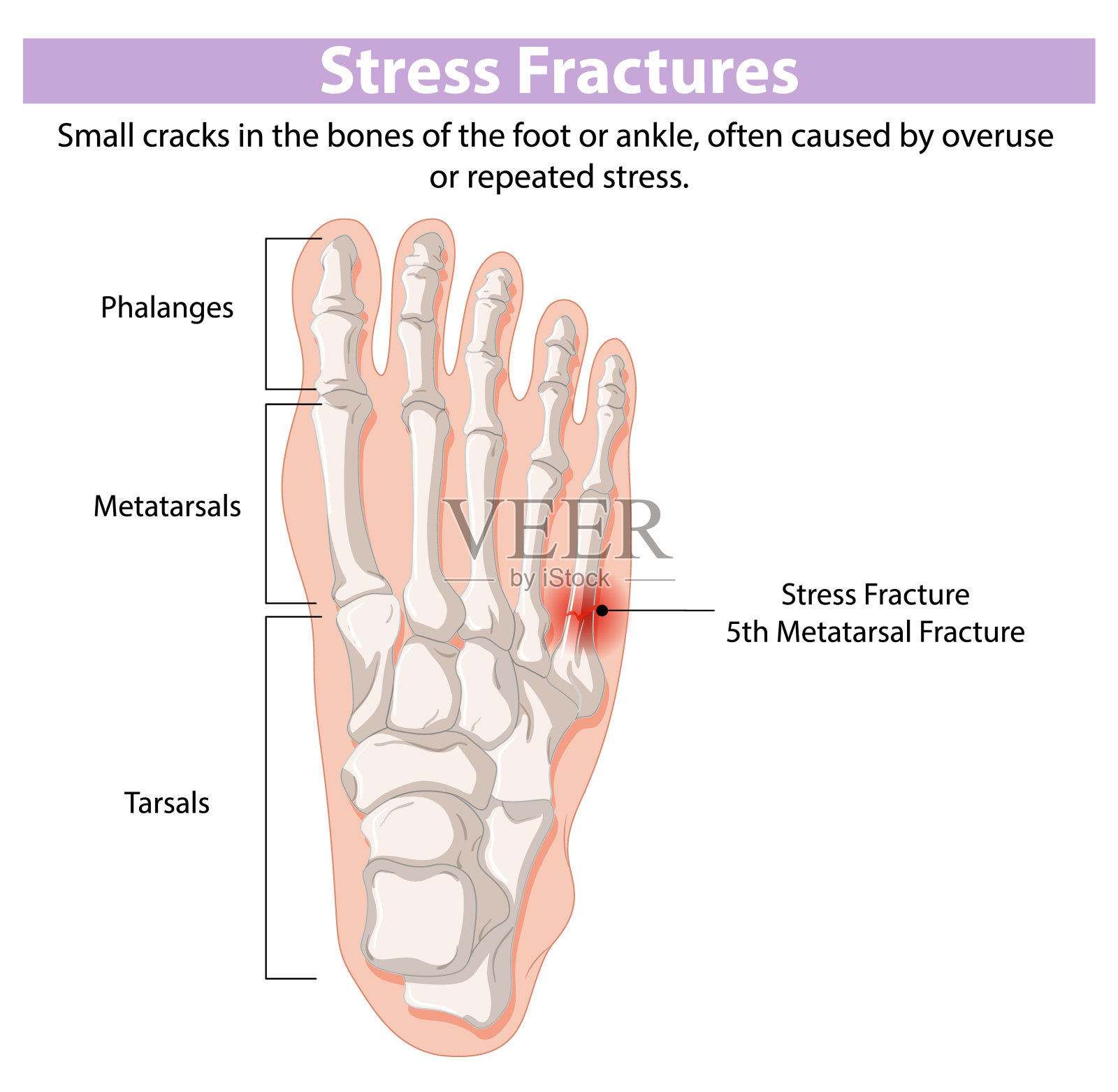 脚部骨骼应力性骨折示意图插画图片素材