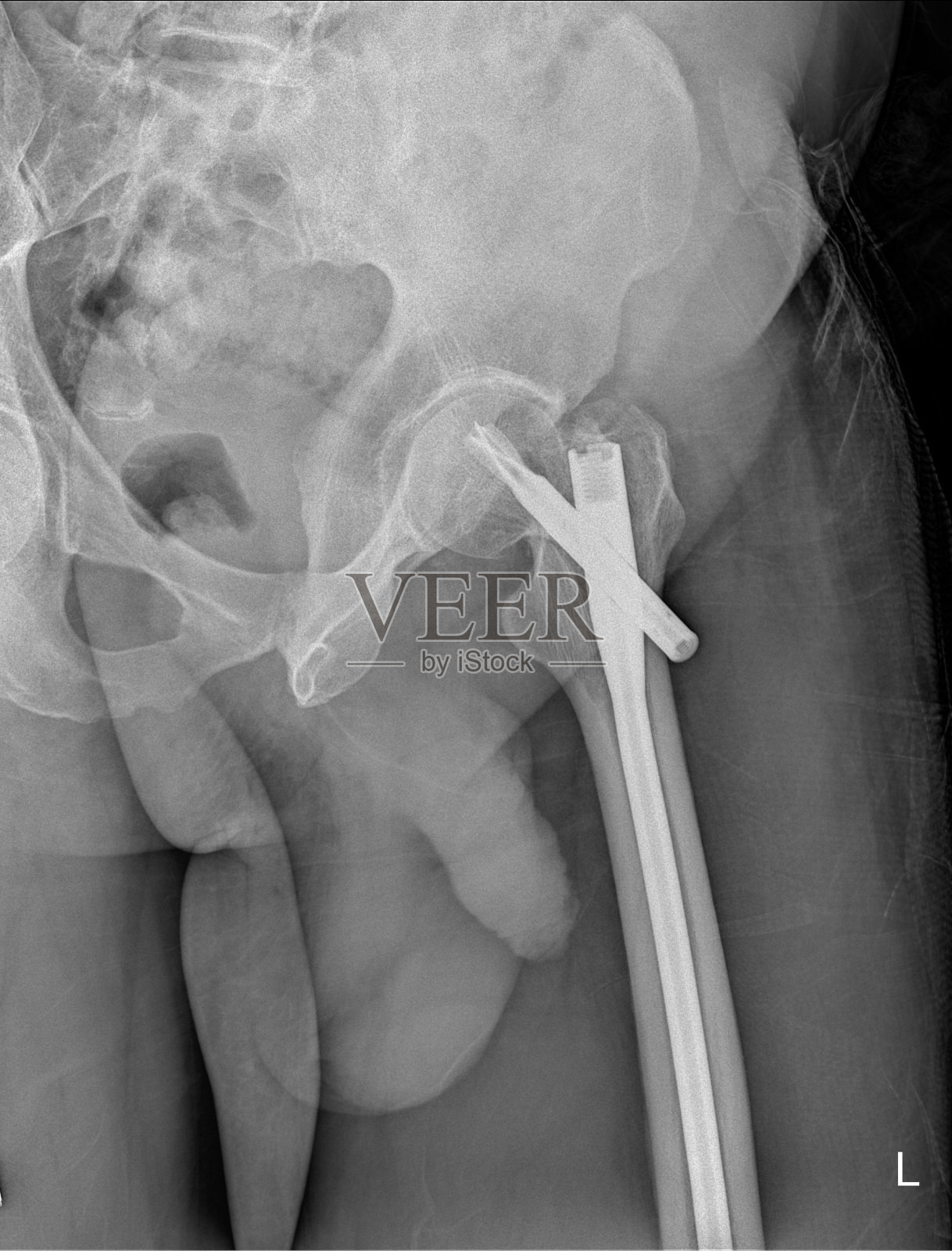 髋关节骨折照片摄影图片