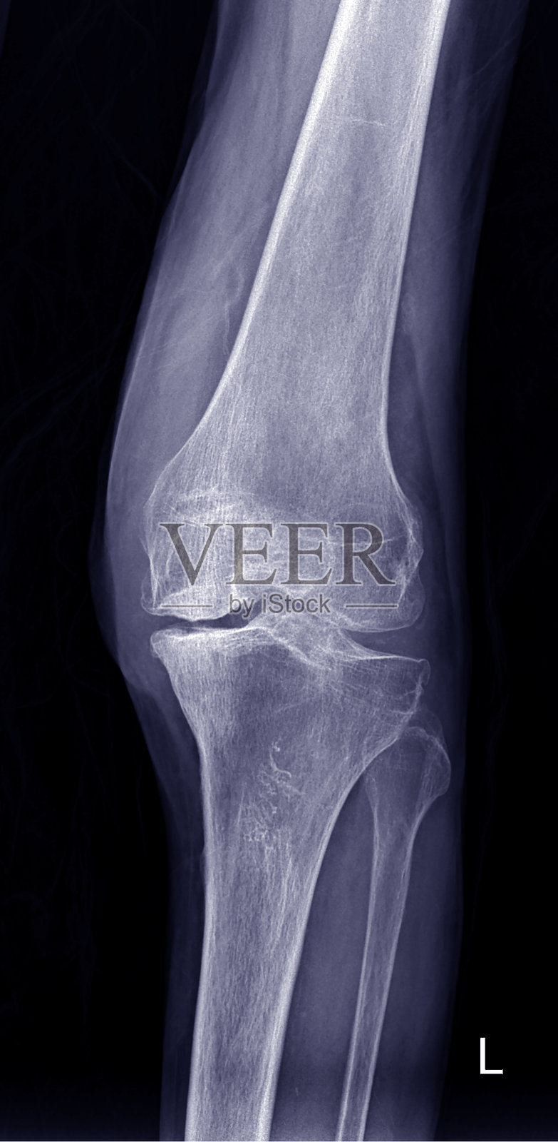 膝关节关节炎的随访x线片照片摄影图片