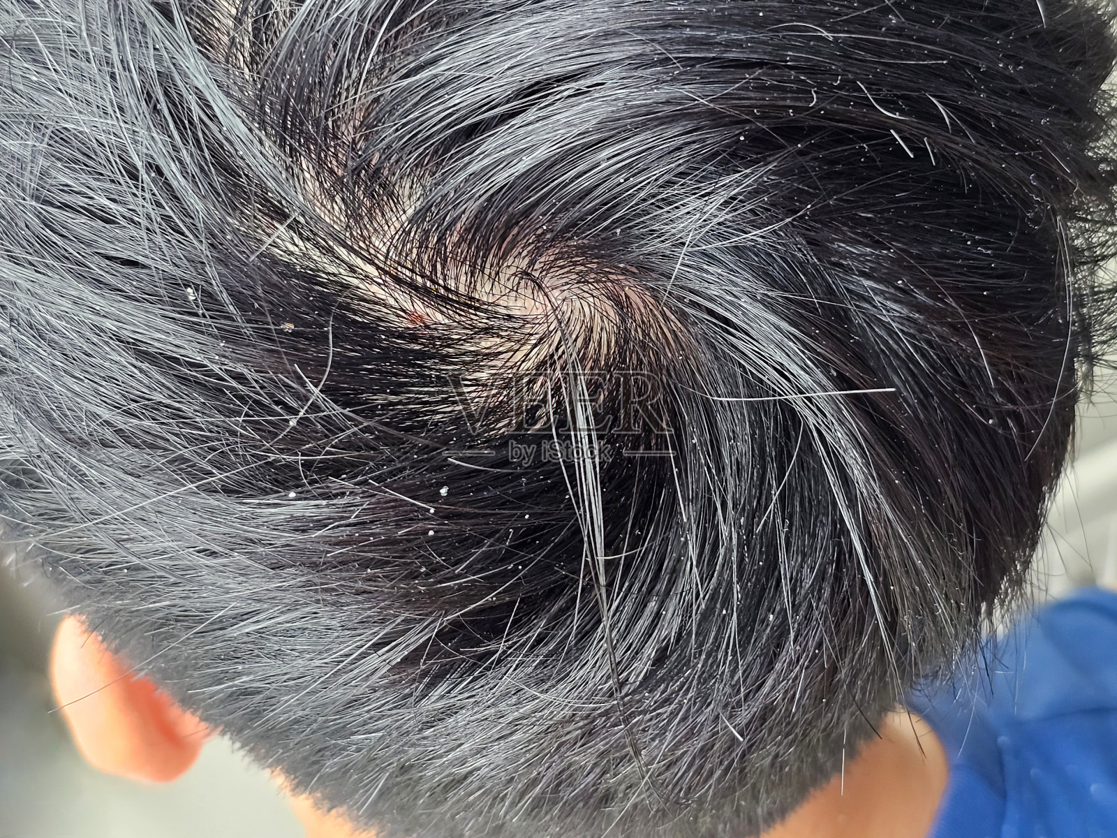 黑头发露出头皮屑的男人。特写视图照片摄影图片