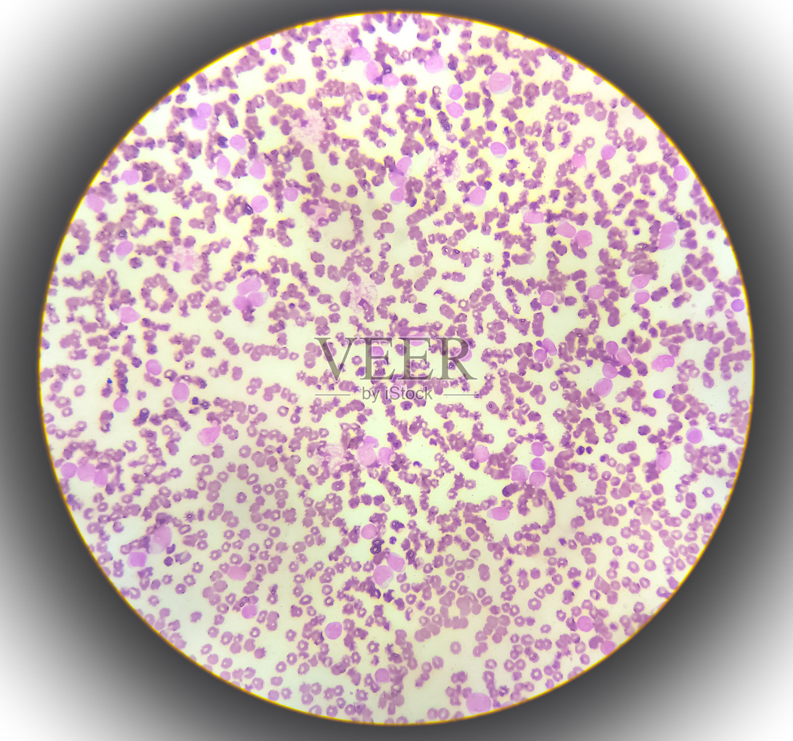 急性髓母细胞白血病(AML)的光镜分析。照片摄影图片