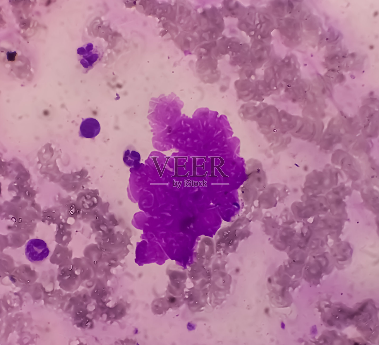 骨髓研究(BMS): panmyelosis。骨髓增生障碍。急性髓性白血病。照片摄影图片