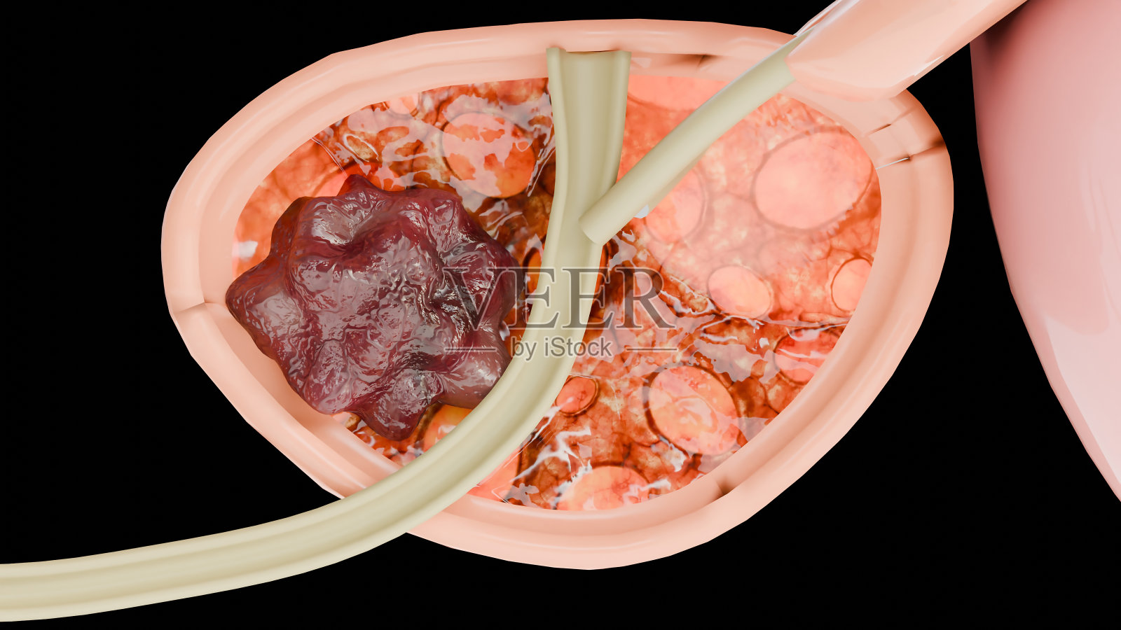 前列腺癌的分期。癌细胞、恶性肿瘤压迫尿道。病理破坏，系统解剖，膀胱肿瘤或泌尿系统疾病，bph, 3d渲染照片摄影图片