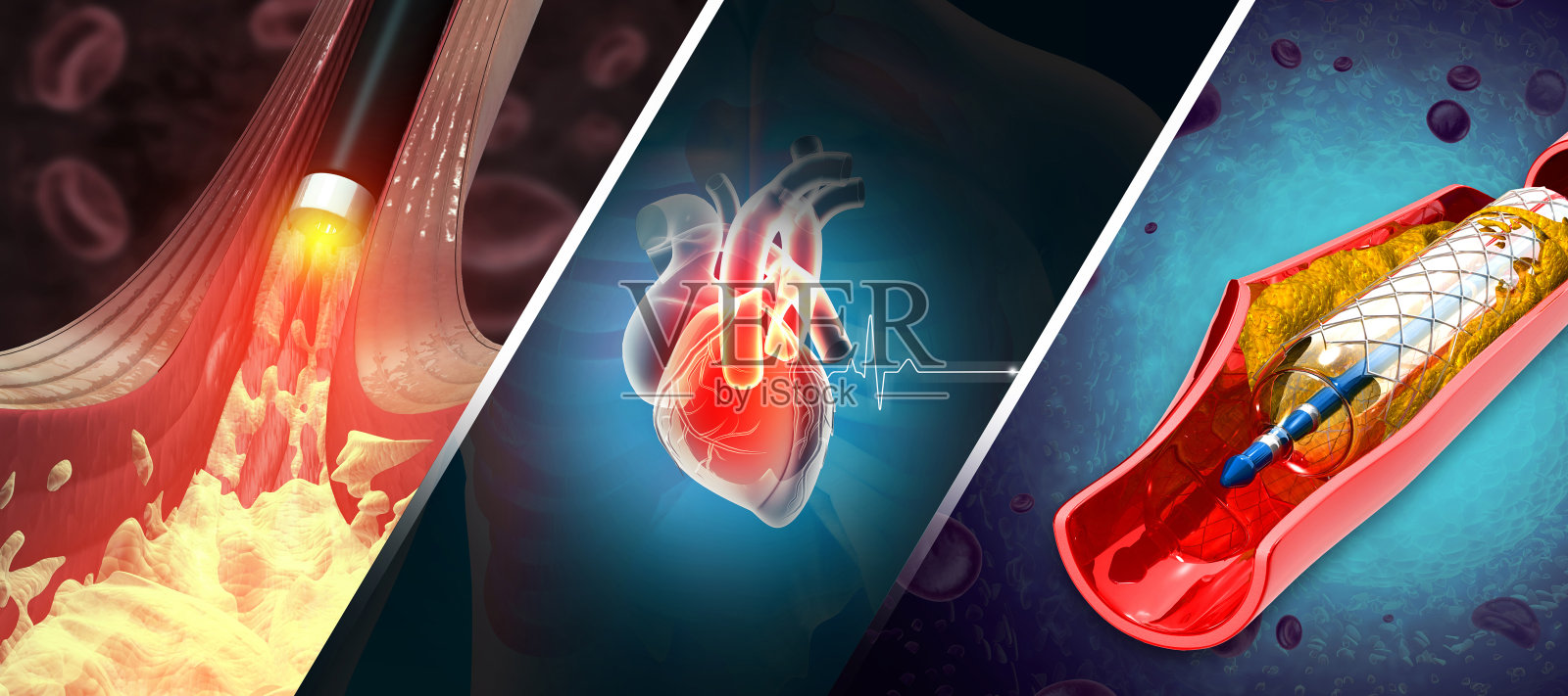 动脉阻塞和动脉粥样硬化疾病。胆固醇阻塞了动脉。支架血管成形术。三维演示照片摄影图片