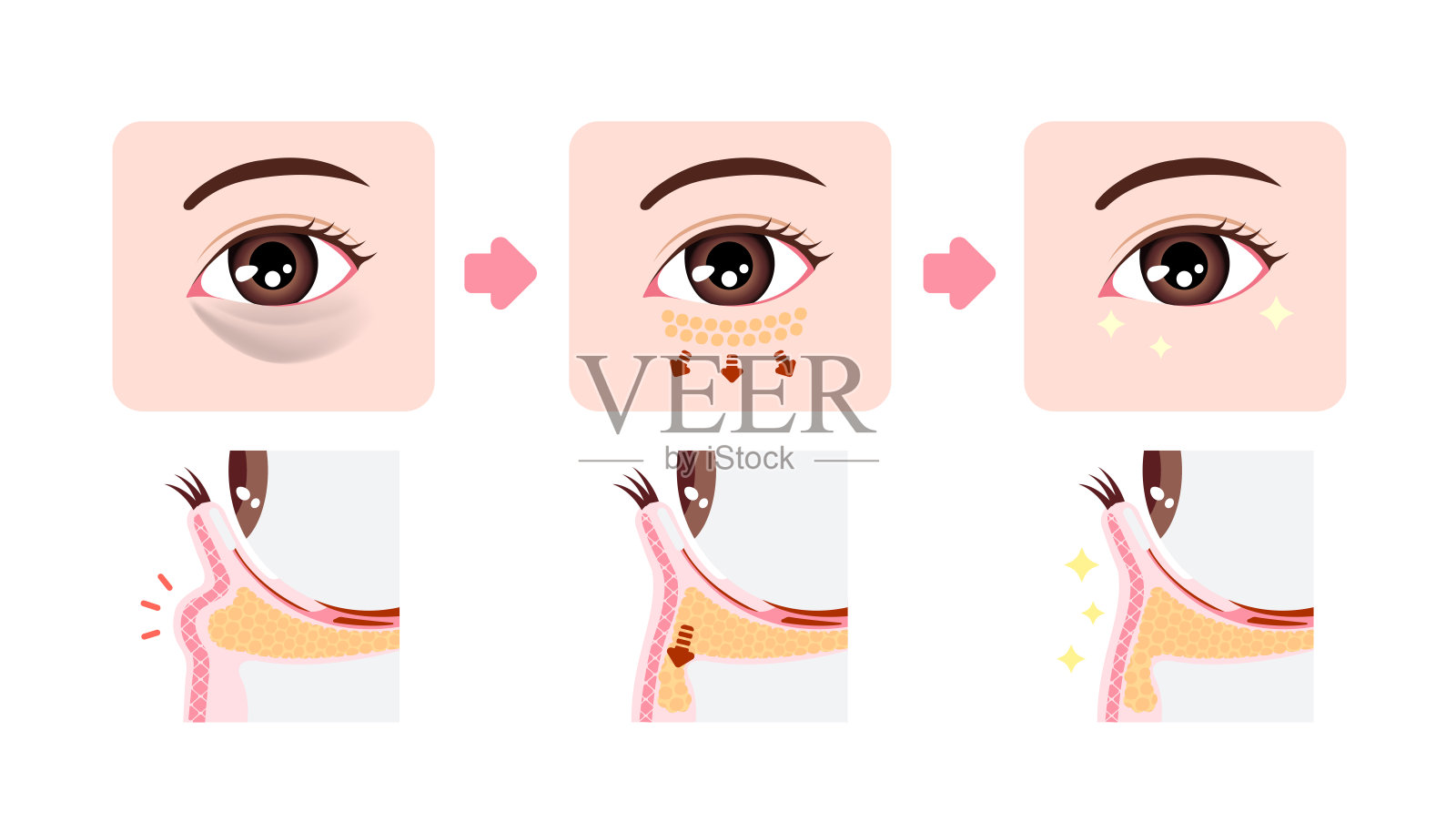 下睑成形术如何去除黑眼圈(经结膜眼睑成形术)插画图片素材