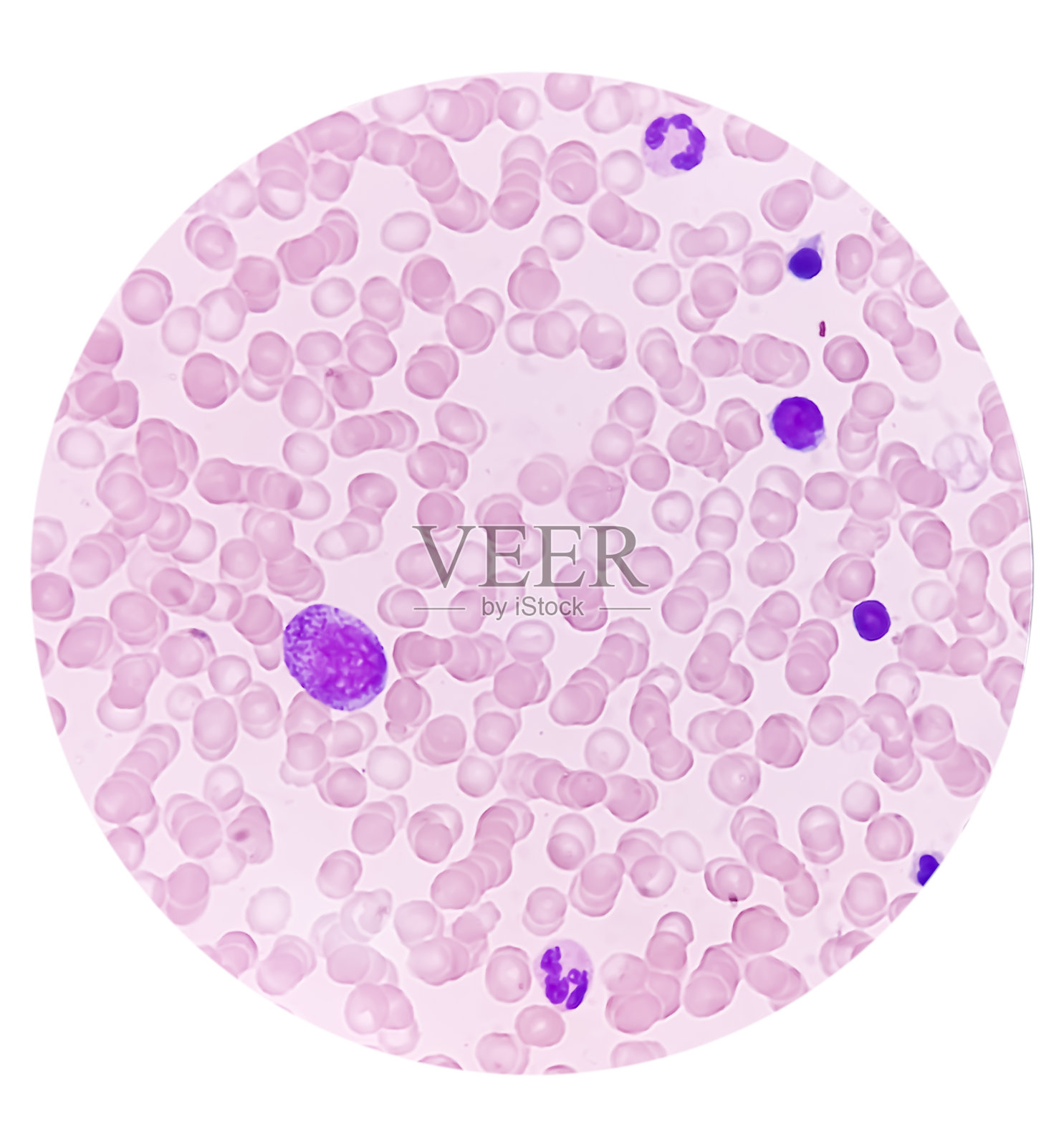 骨髓检查，显微镜下显示巨核细胞多形性。巨核细胞的增生。照片摄影图片