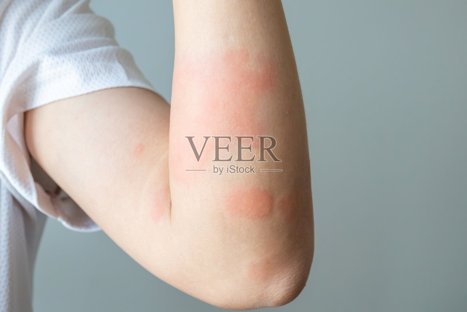 年轻的亚洲男子瘙痒和抓挠的手臂过敏性瘙痒干燥皮肤湿疹皮炎昆虫叮咬照片摄影图片