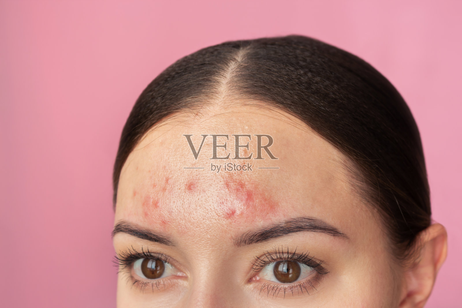 额头上有粉刺的女人的照片。她患有一种慢性皮肤病，病情加重了。照片摄影图片