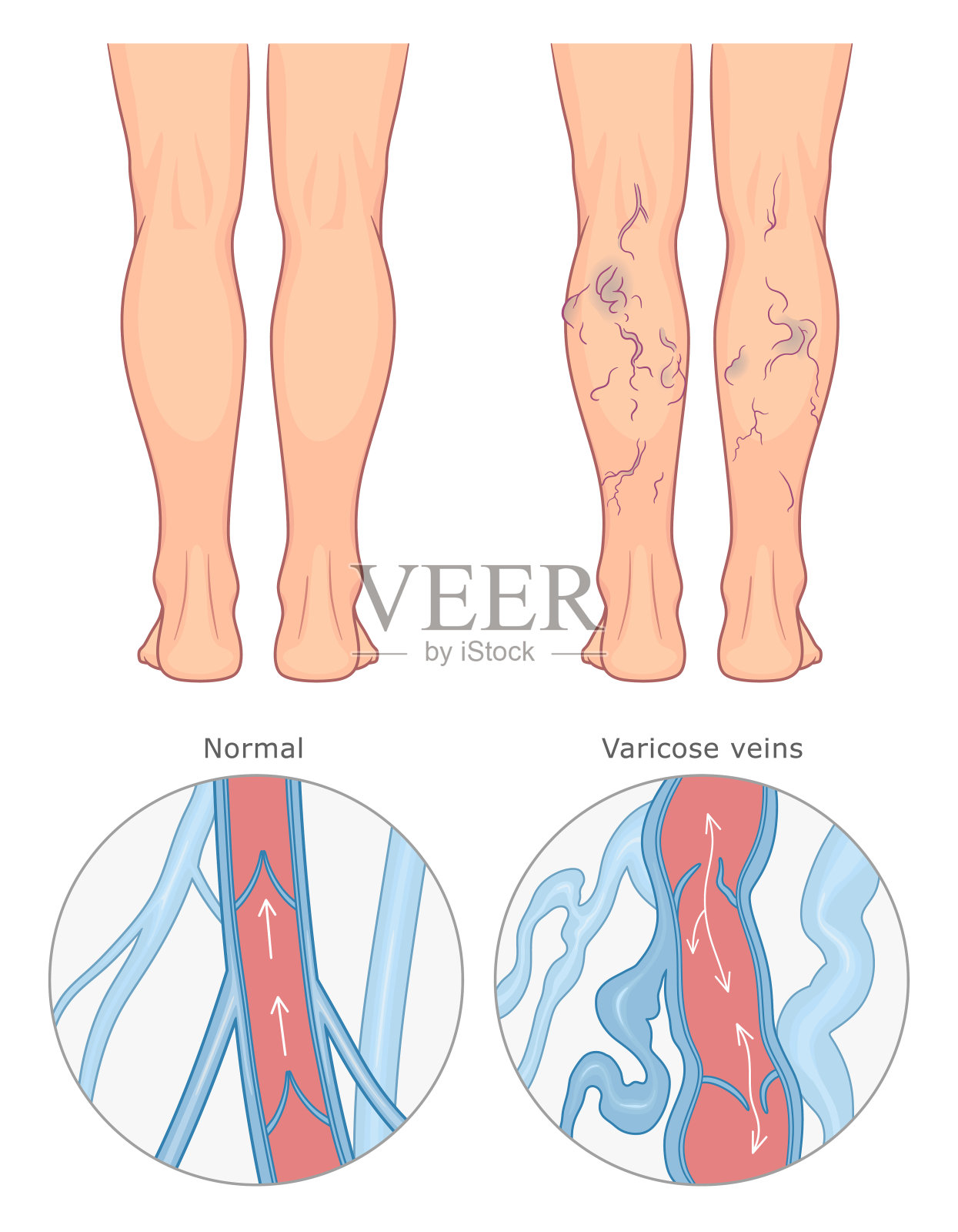 静脉曲张医学插图插画图片素材