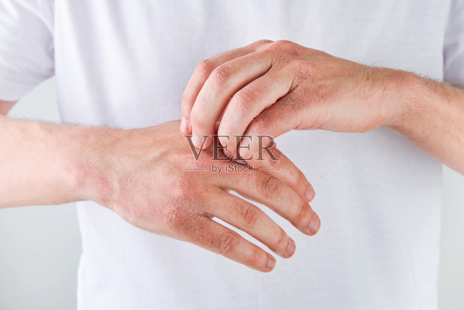 男子在白色背景上用干裂的皮肤抓挠或露出双手。许多人的问题-手上有湿疹，过敏或皮肤干燥。医疗保健理念。关闭了。照片摄影图片