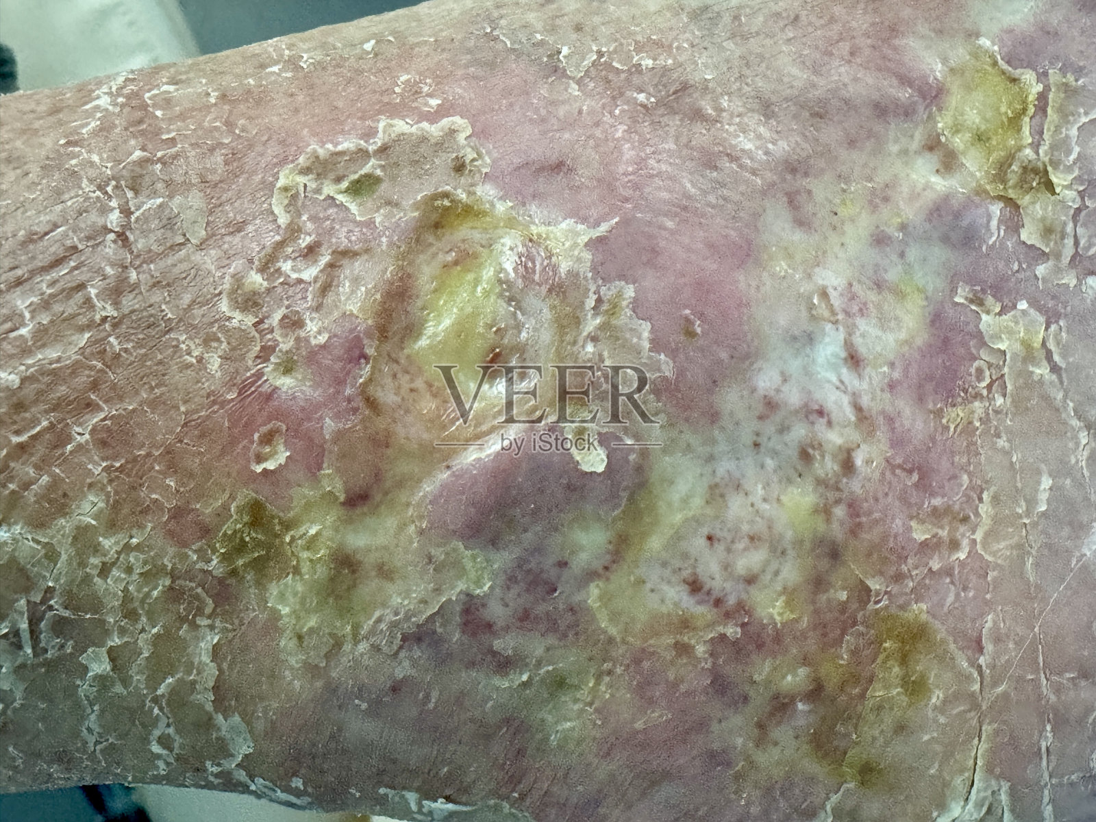 纤维蛋白覆盖溃疡照片摄影图片