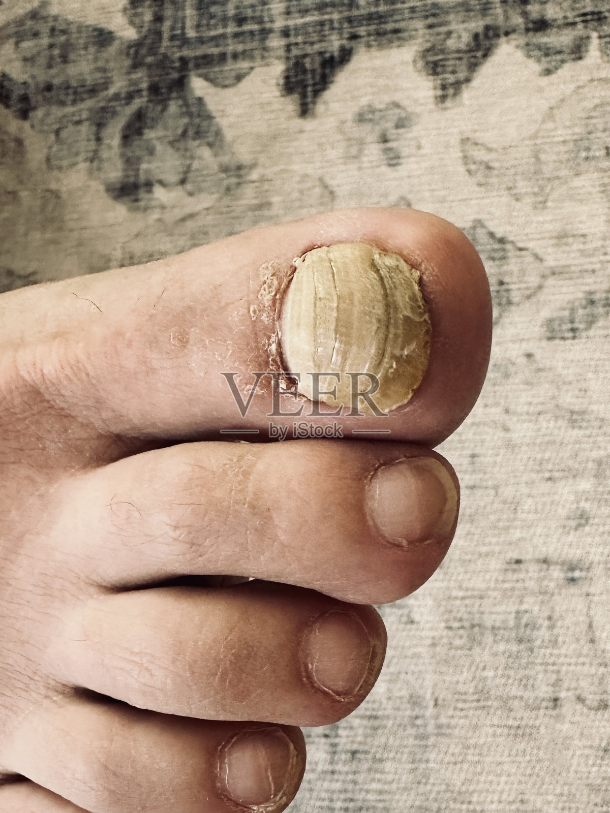 脚趾真菌照片摄影图片