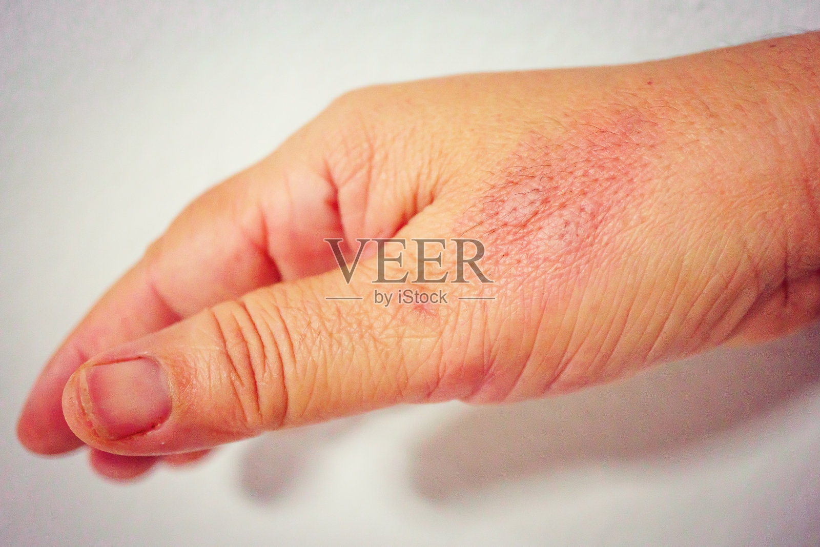 裁剪的手与蚊子叮咬对白色背景照片摄影图片