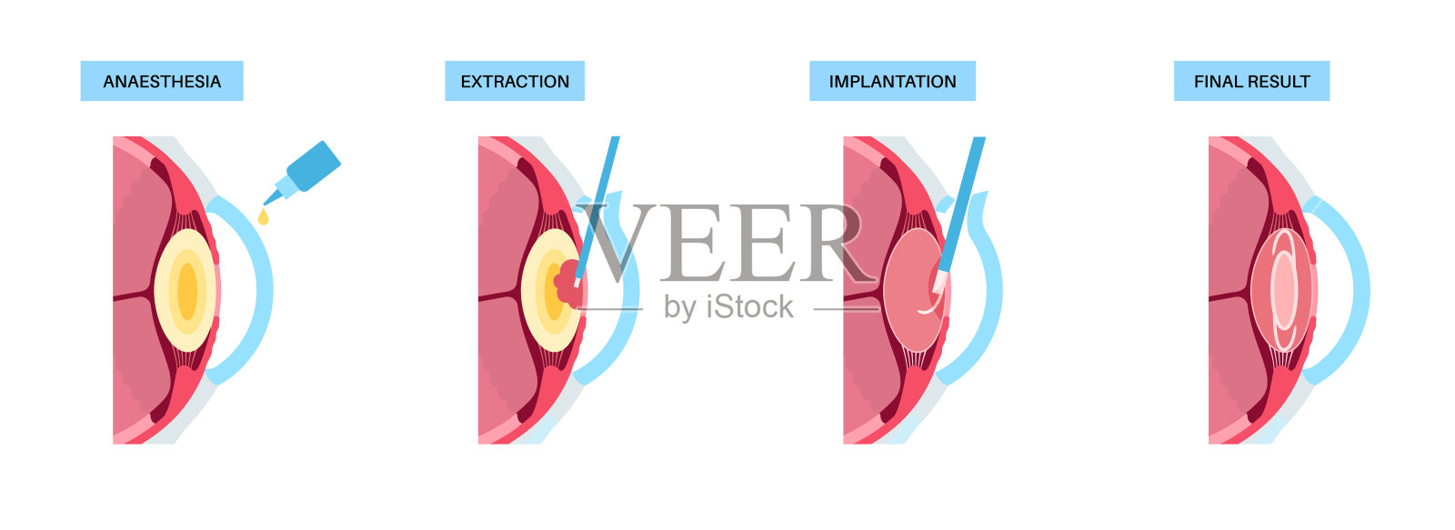 白内障手术海报插画图片素材