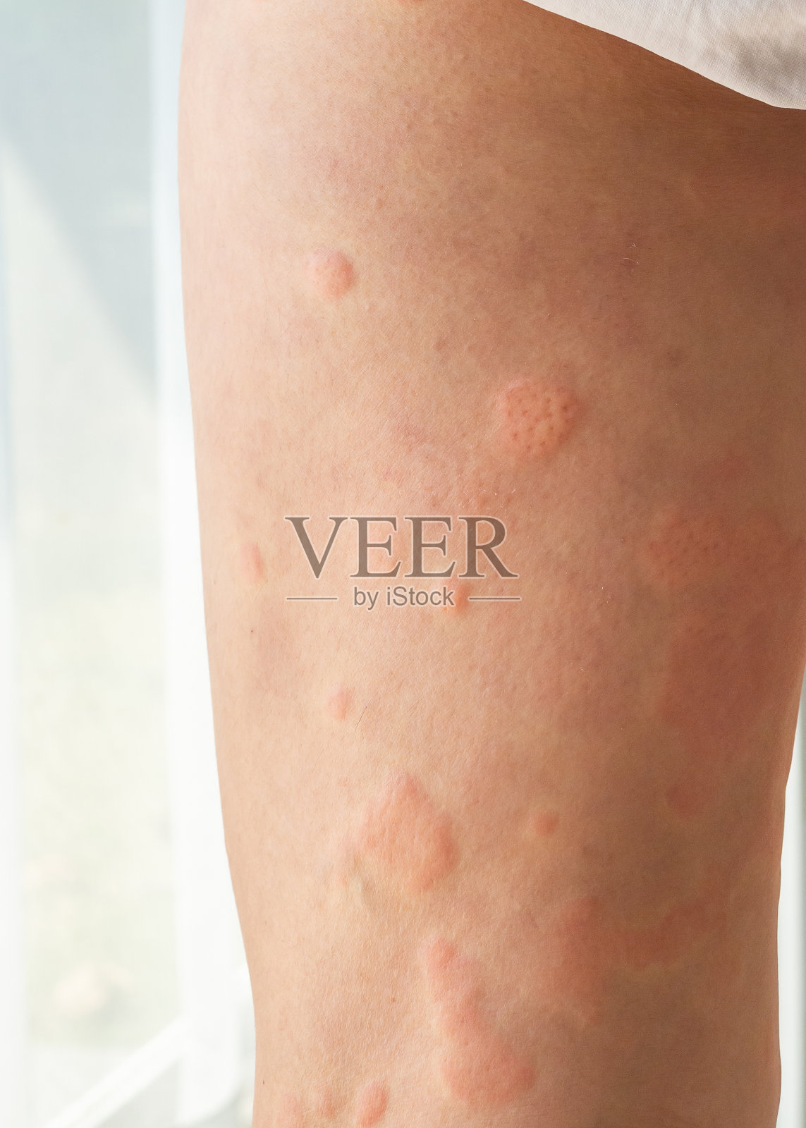 一名年轻的亚洲男子因皮肤干痒、湿疹、皮炎、昆虫叮咬而在腿上出现过敏性皮疹照片摄影图片