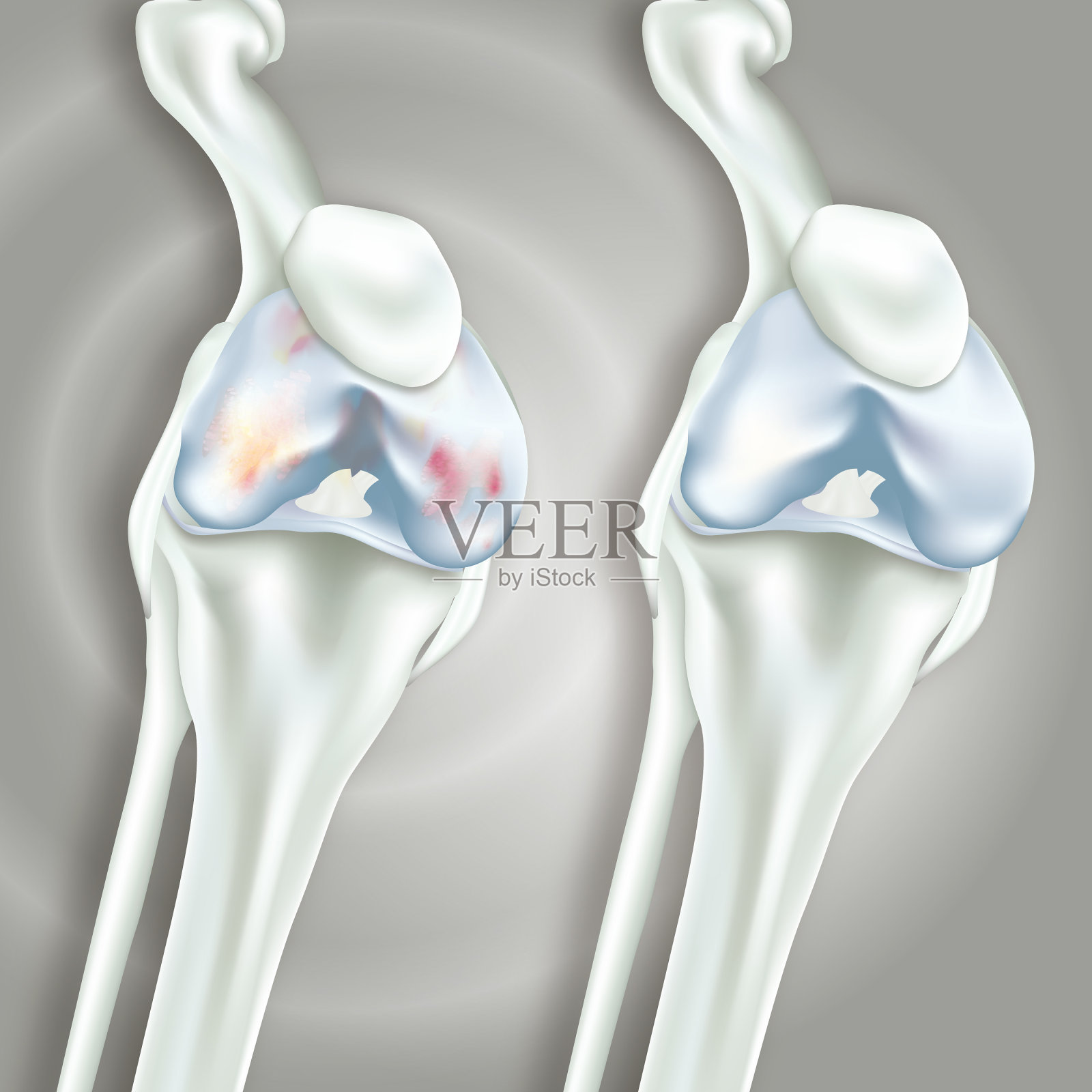 膝关节置换术插画图片素材