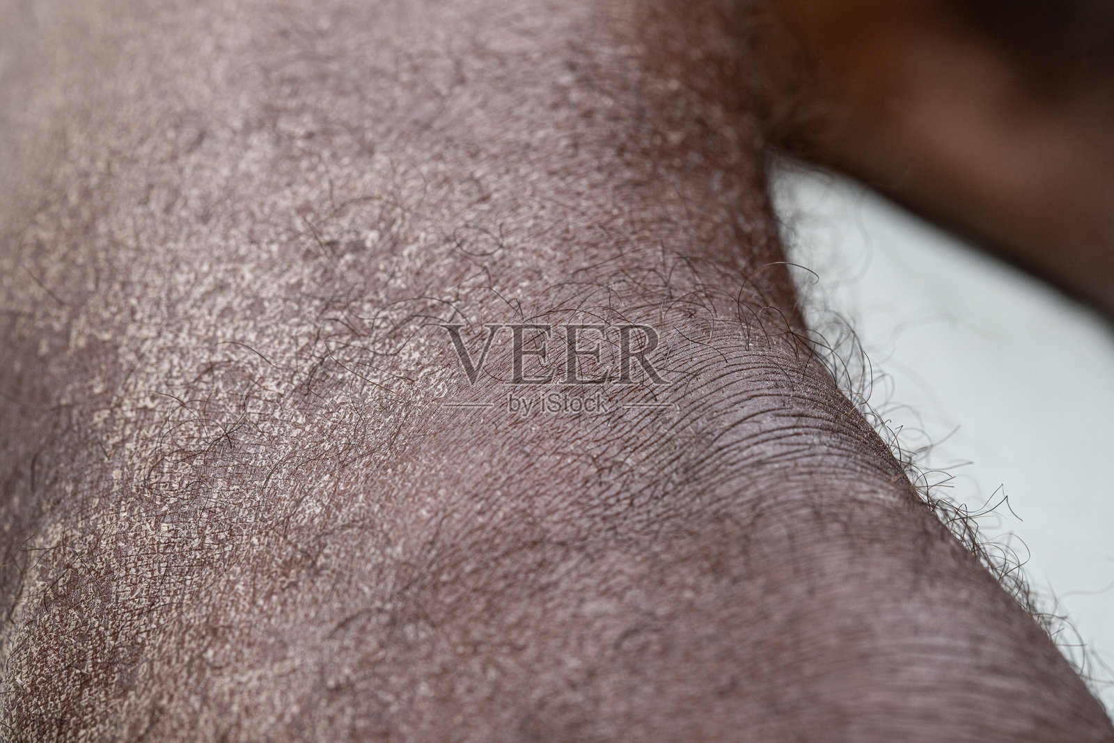 显示湿疹症状的干燥皮肤特写照片摄影图片