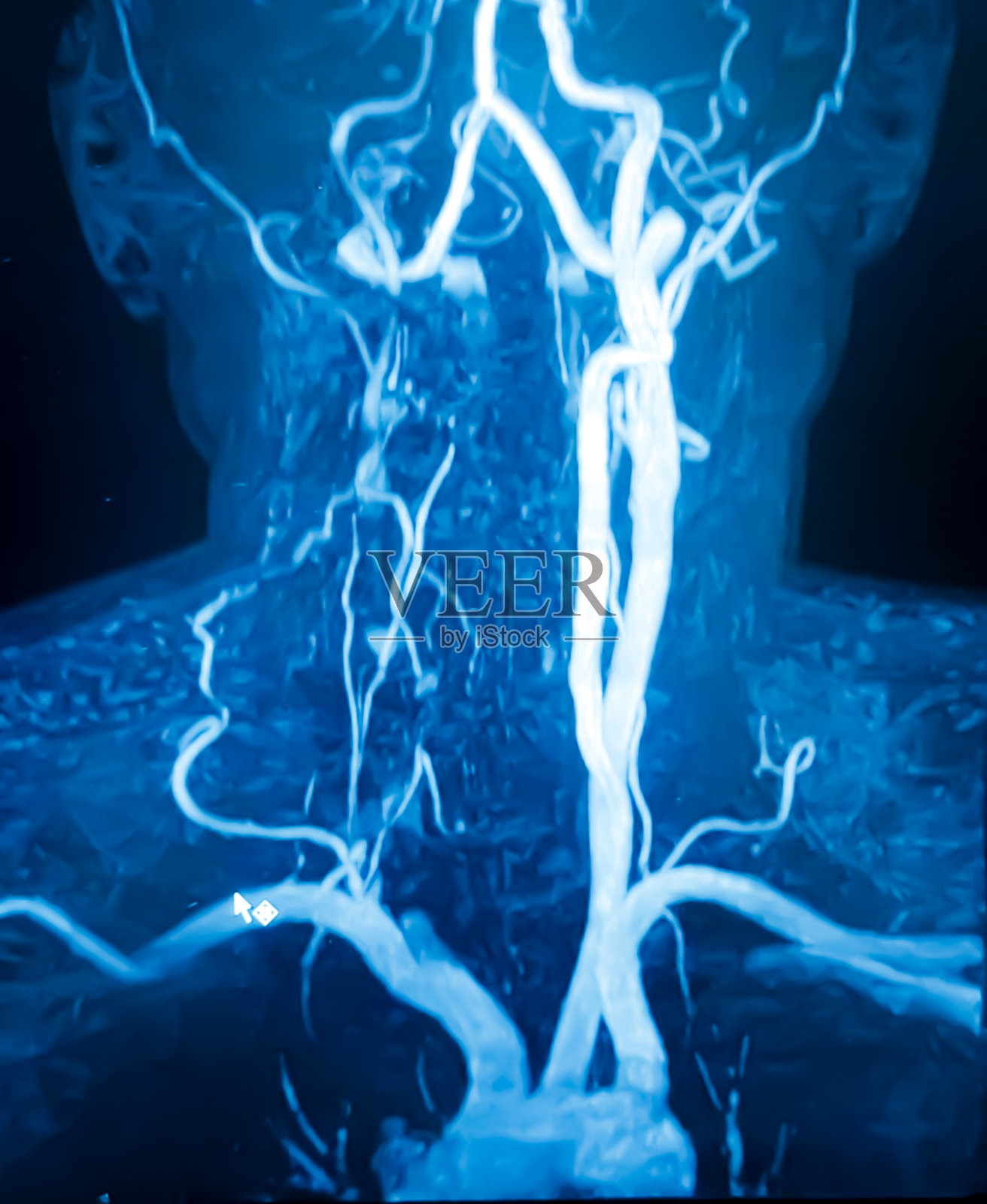 Cta大脑3D渲染。右颈总动脉阻塞。三维演示照片摄影图片