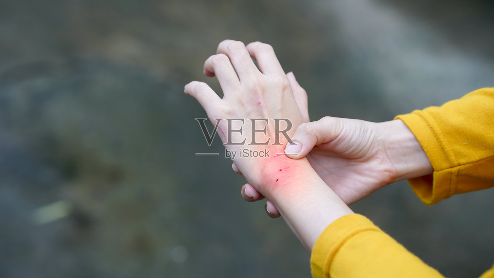 一个穿着黄色袖子的人，手握发炎的红手腕，在模糊的背景上表示疼痛或皮肤状况。照片摄影图片