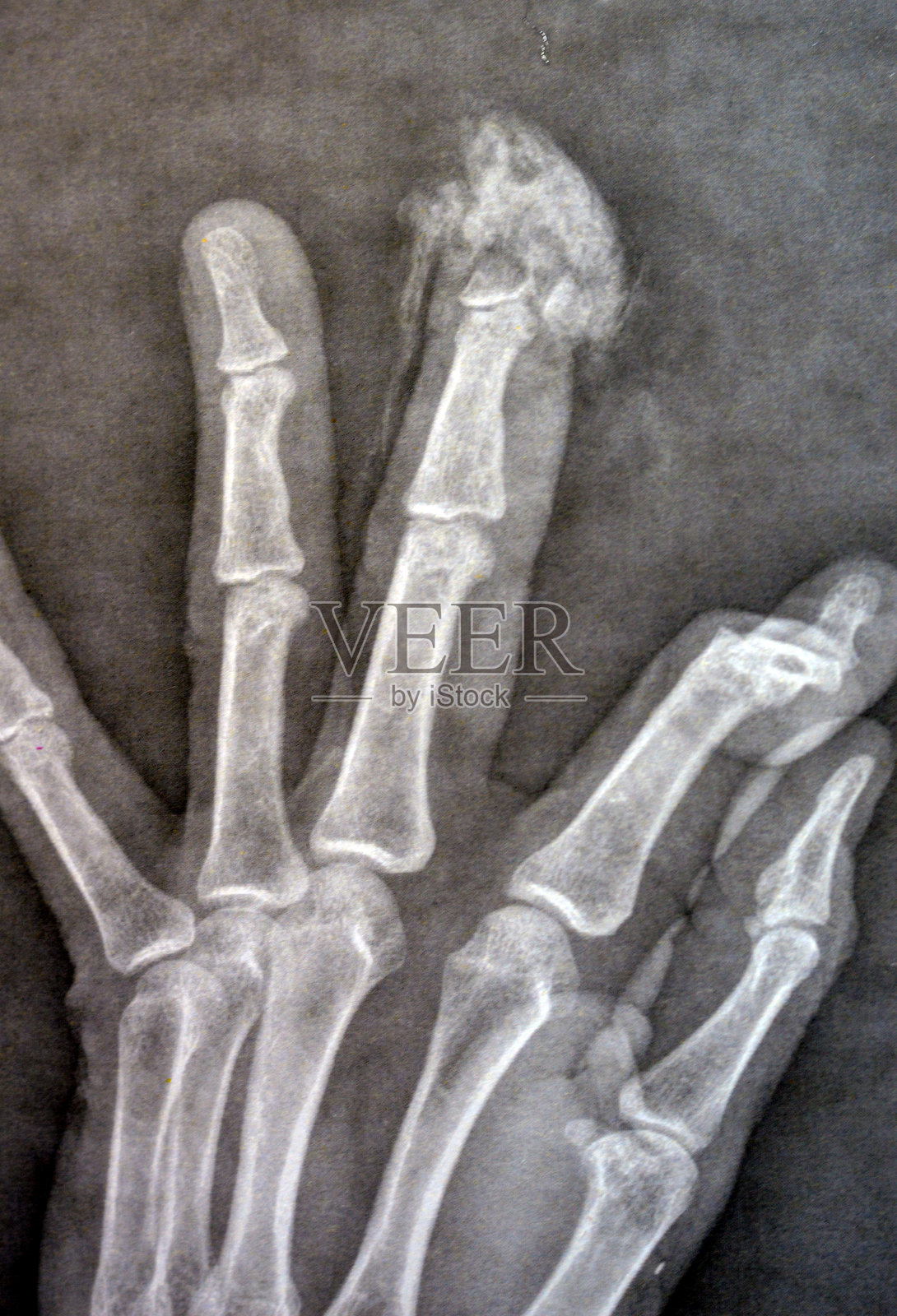 X光片显示：成年男子左手中指末节指骨远端截肢，由锋利的刀片机器造成照片摄影图片