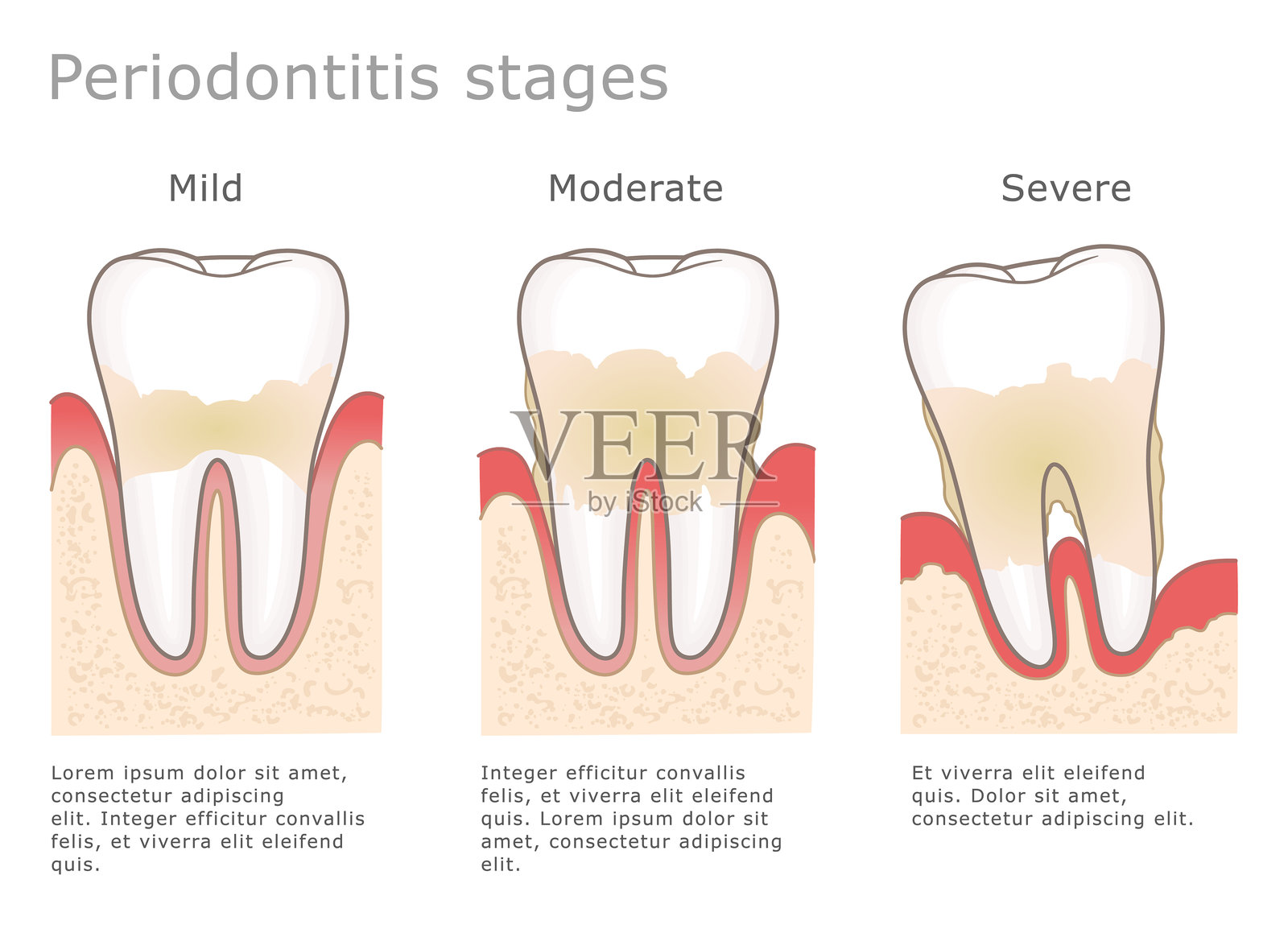 牙周炎阶段医学说明插画图片素材