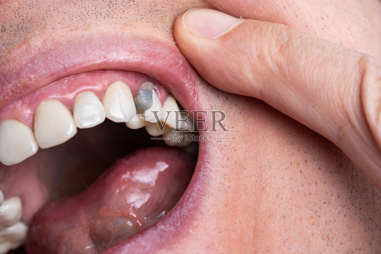 牙科根管治疗后，上颌前磨牙断裂的白人男性张开嘴露出牙齿。永久新牙冠前的深灰色牙科水泥。特写微距拍摄照片摄影图片