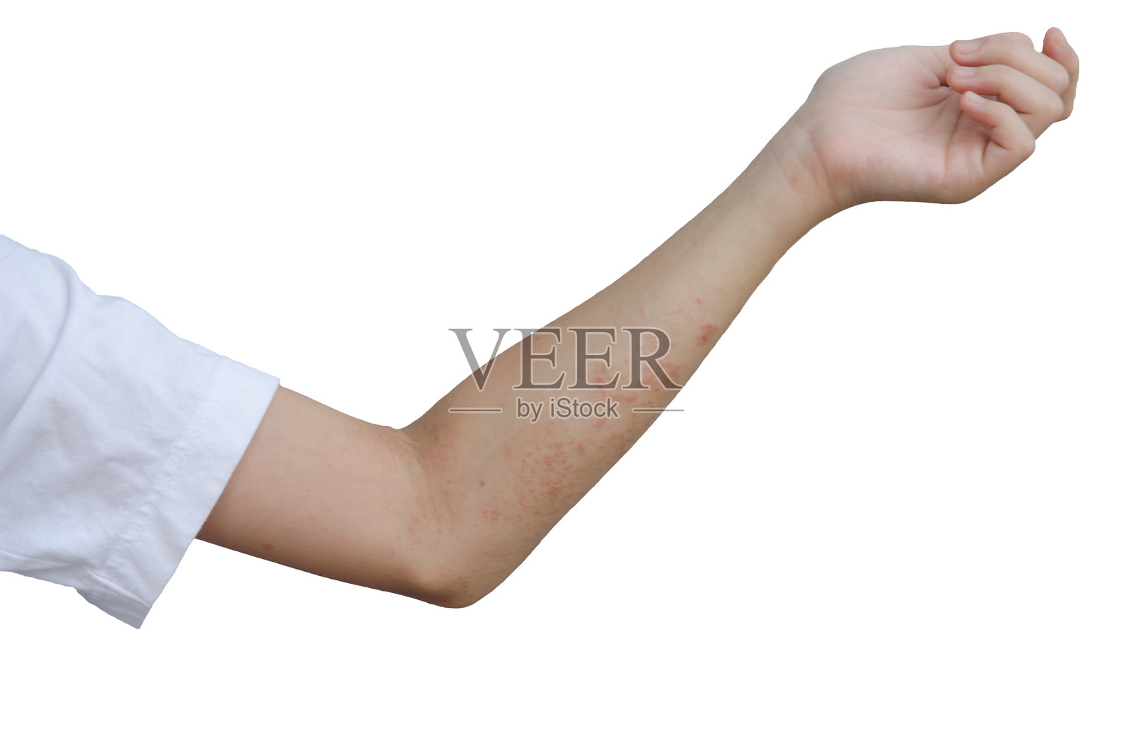 手部特写，显示疾病的症状照片摄影图片