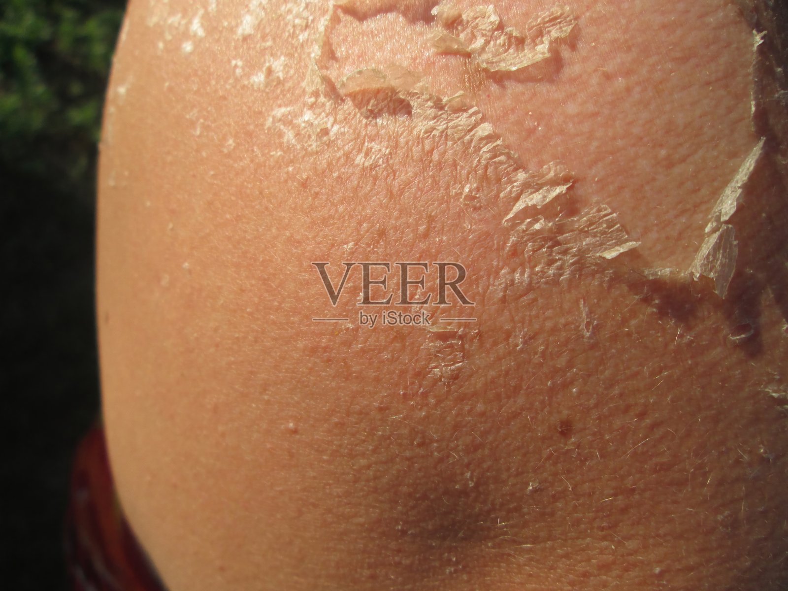 特写镜头显示肩部脱皮，表明在温暖天气下户外海滩度过一天后，严重晒伤的情况。照片摄影图片