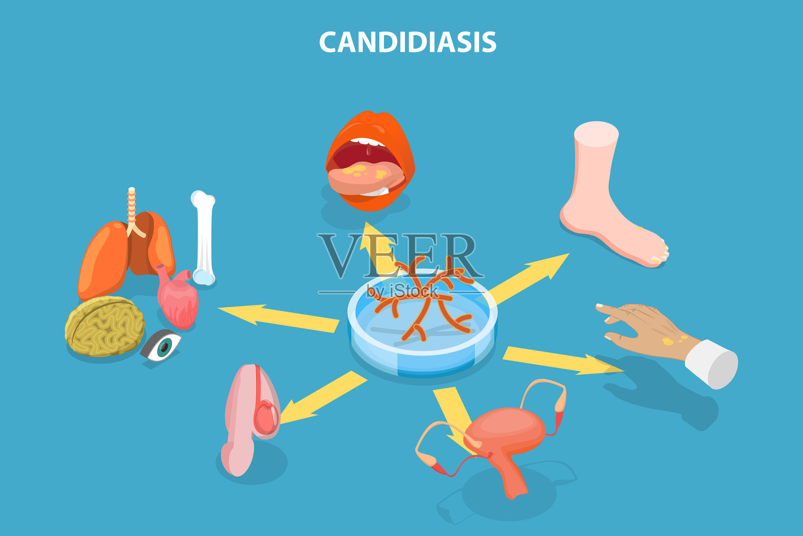 3D等距平面矢量插图展示念珠菌病插画图片素材