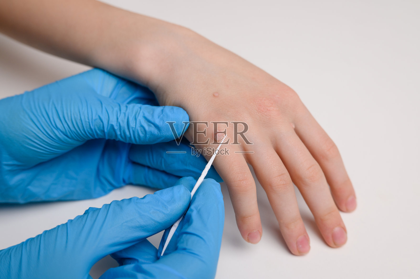 医生戴着蓝色手套检查患有病毒性疣（普通疣）的儿童手部，并用治疗疣的溶液进行处理，特写。人乳头瘤病毒，HPV。儿科皮肤病学和皮肤疾病的概念。照片摄影图片