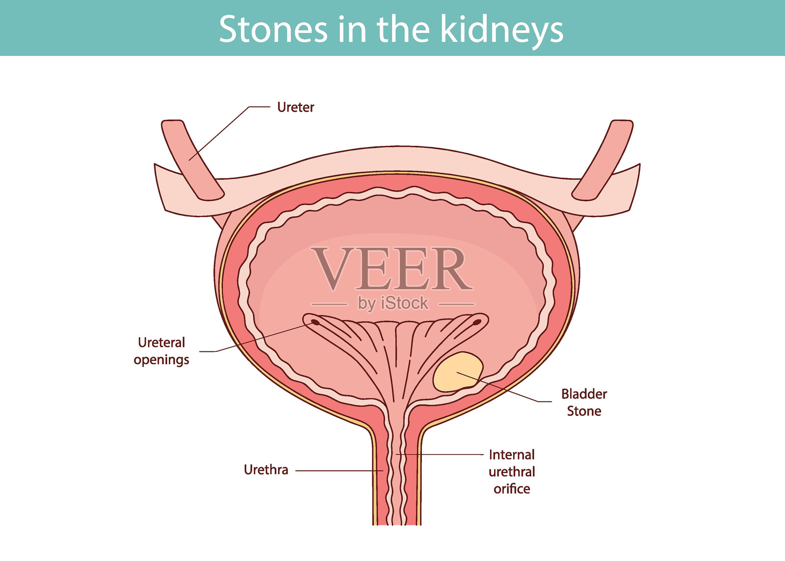 膀胱解剖图。膀胱结石图解。手绘矢量插图。插画图片素材