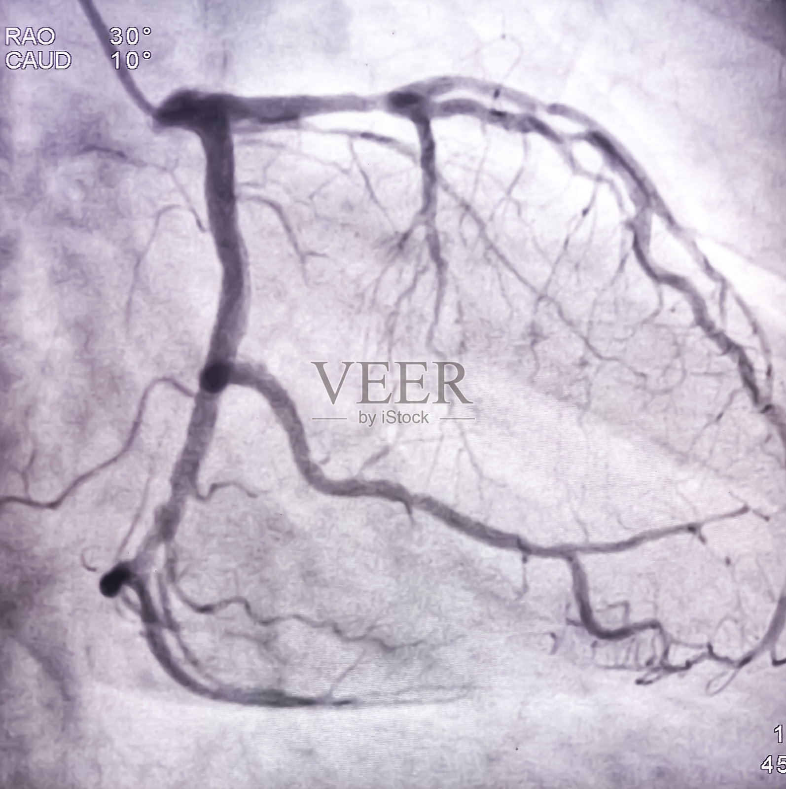 左冠状动脉在心脏导管插入术中使用对比剂进行的冠状动脉造影。异常发现。调整颜色。照片摄影图片