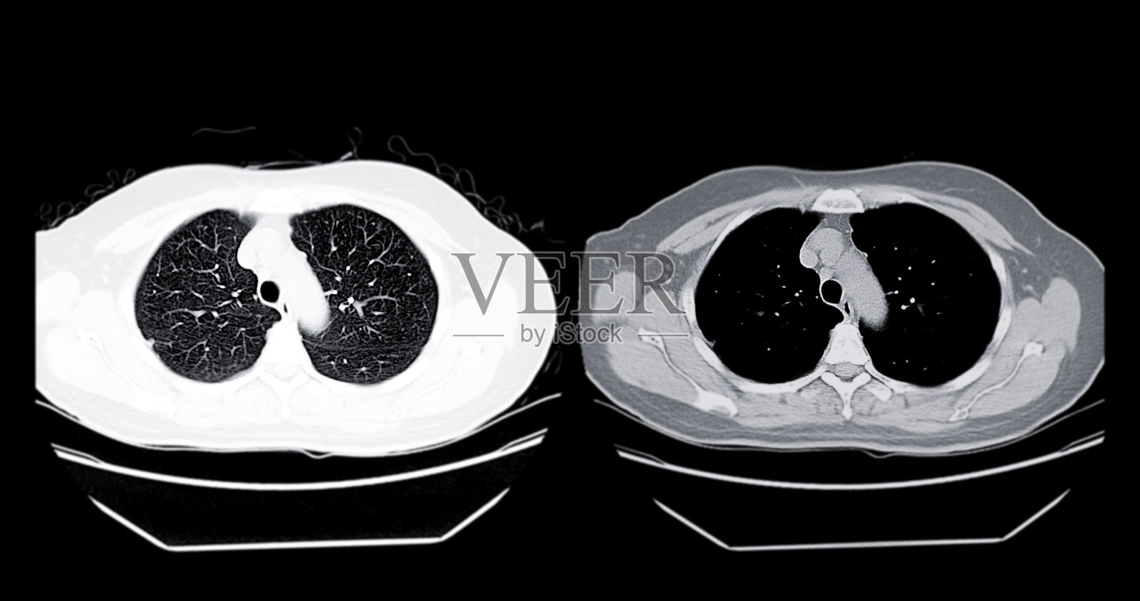 胸部CT扫描，展示肺部和心脏，用于诊断呼吸系统疾病和评估胸腔区域的详细横截面图像。照片摄影图片