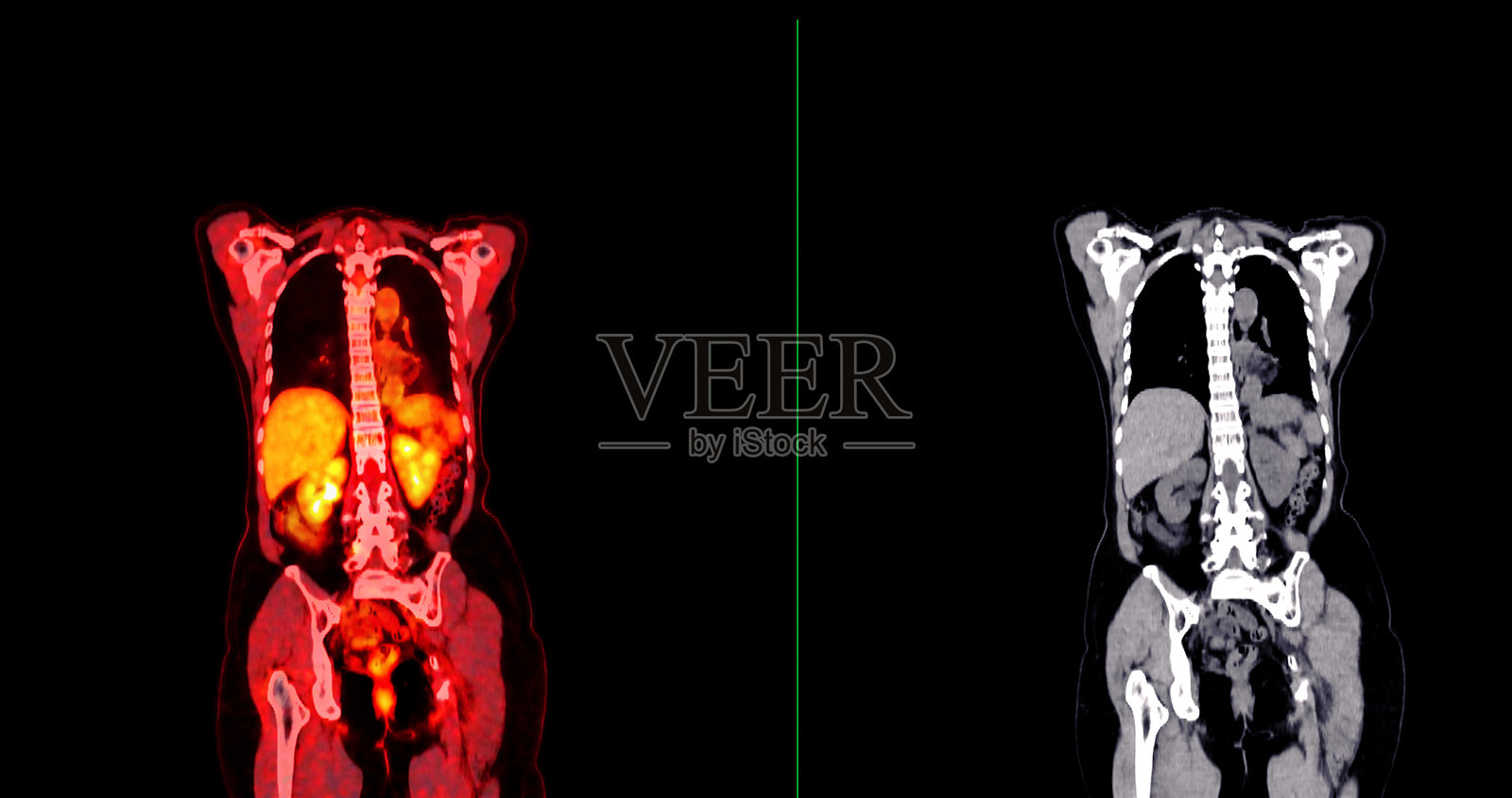 PET扫描图像显示侧面轮廓的全身代谢活动。适用于医学教育、诊断和细胞功能研究。照片摄影图片