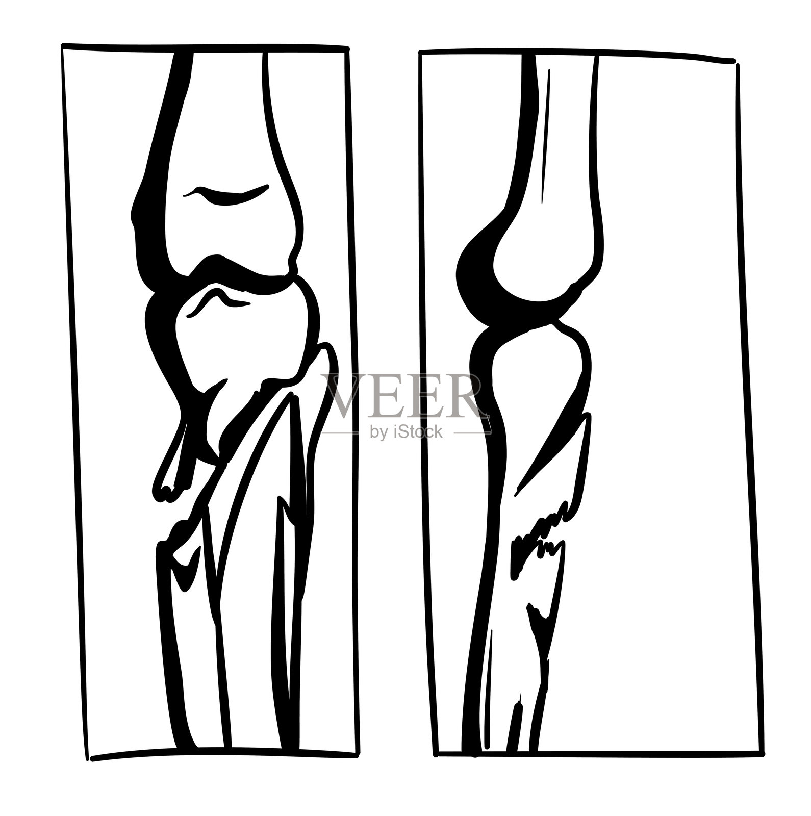 胫骨X光骨折图像插画图片素材