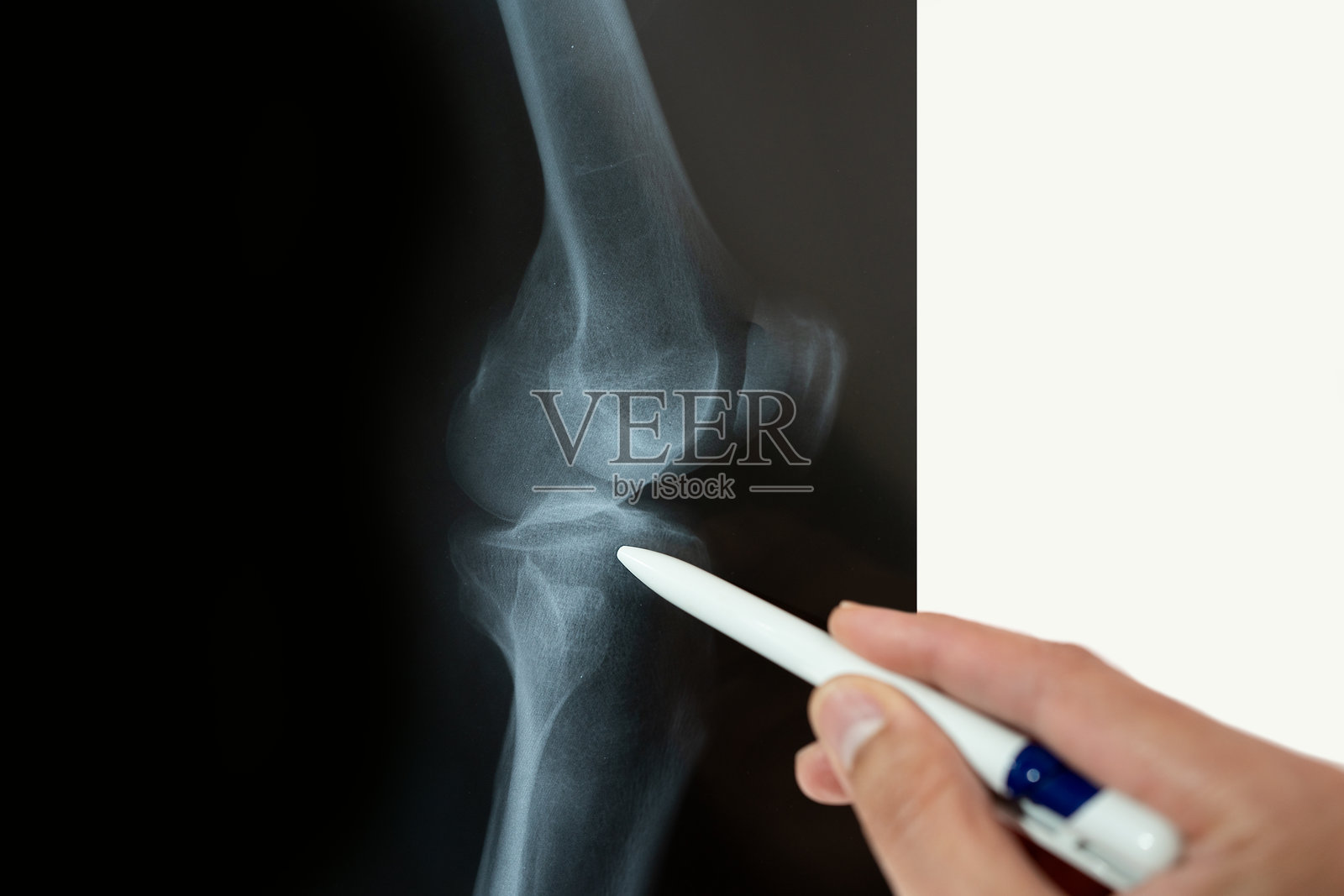 医生正在通过X光分析膝盖照片摄影图片
