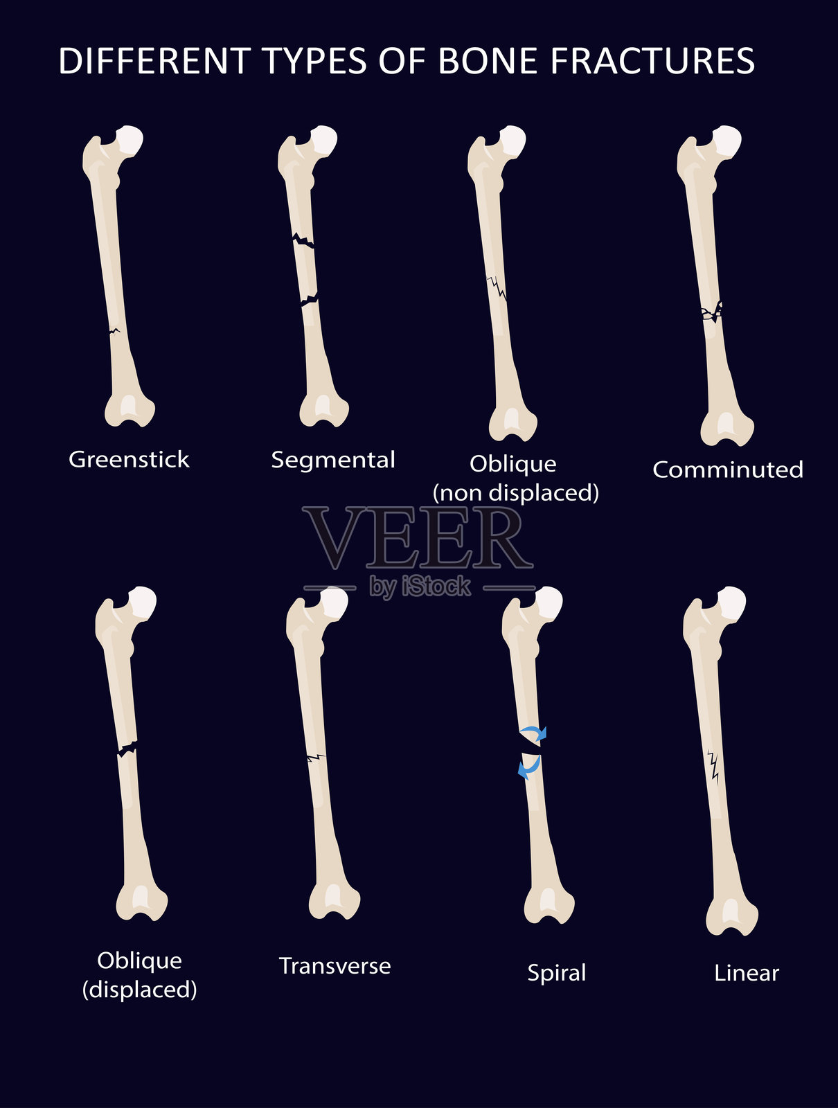 骨折类型矢量插图插画图片素材