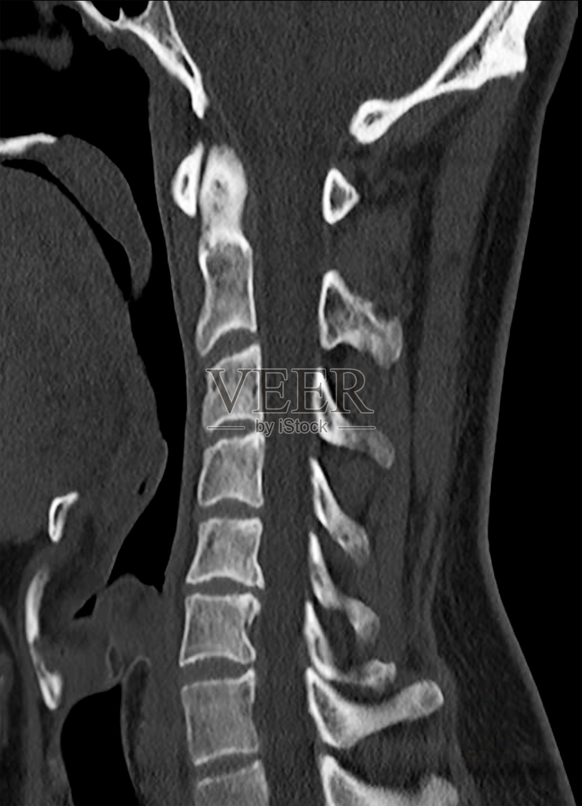 一张侧面显示男性成人颈部和脊柱的CT扫描，清晰展示肌肉和骨骼结构。照片摄影图片