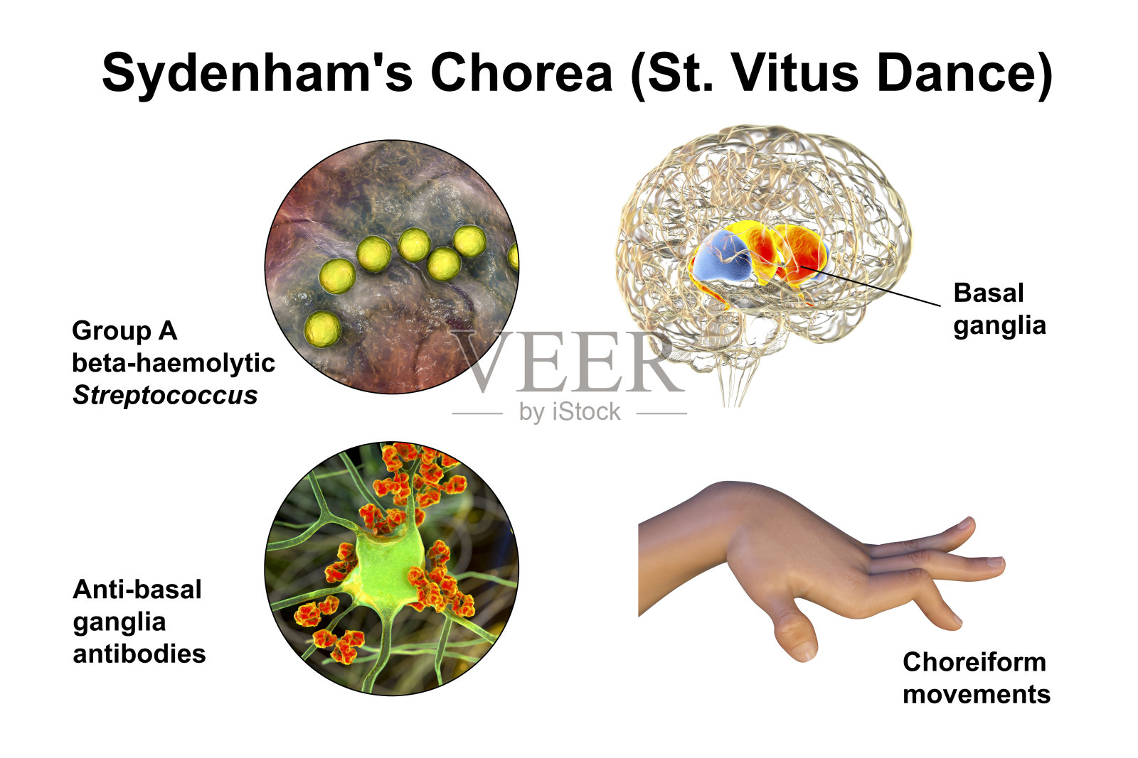 西登汉舞蹈症，一种由儿童感染链球菌引起的自身免疫疾病，艺术作品照片摄影图片