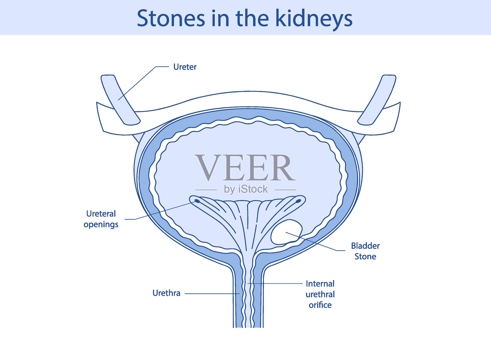 膀胱解剖图。膀胱结石图解。手绘矢量插图。插画图片素材